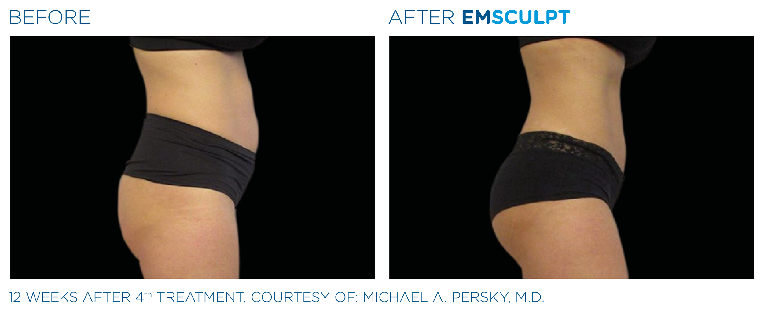 Side-by-side comparison of a woman's waist and hips showing before and after results of EMSCULPT treatment, with significant contour improvements 12 weeks after the fourth session.
