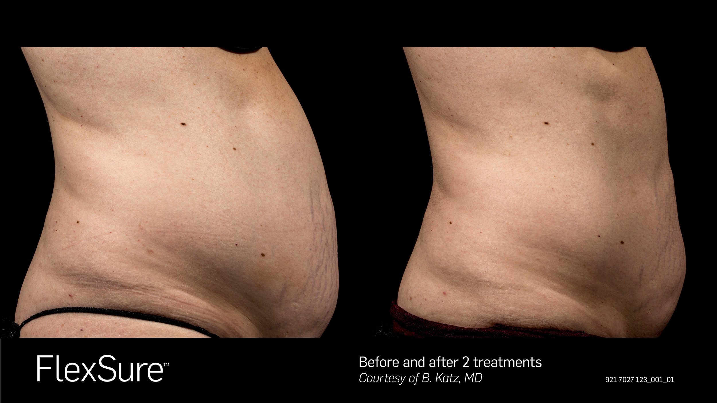 Side-by-side comparison of a woman's abdomen before and after two treatments with FlexSure; the image shows skin tightening and reduction of loose skin in the after photo