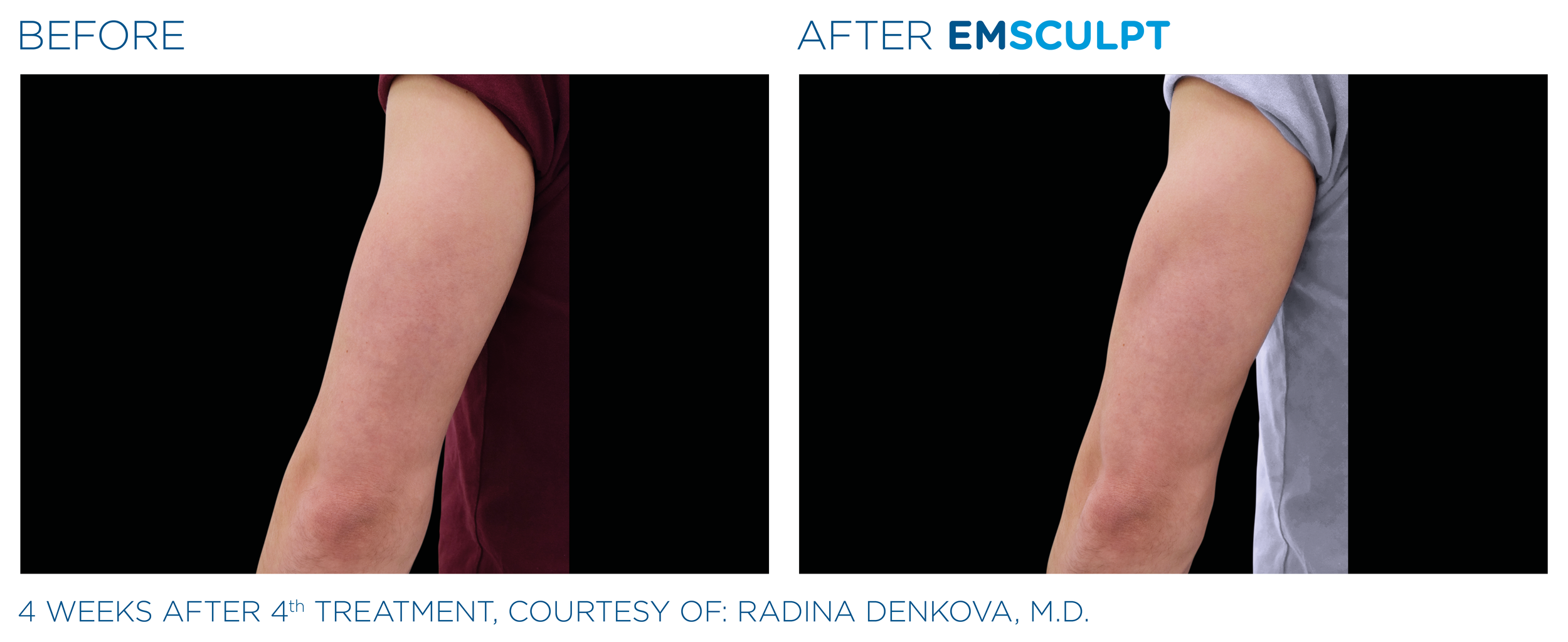 Side-by-side comparison of a person's underarm showing skin before and after four weeks of EMsculpt treatment. The 'before' side shows more skin irregularities, while the 'after' side appears smoother and more toned.