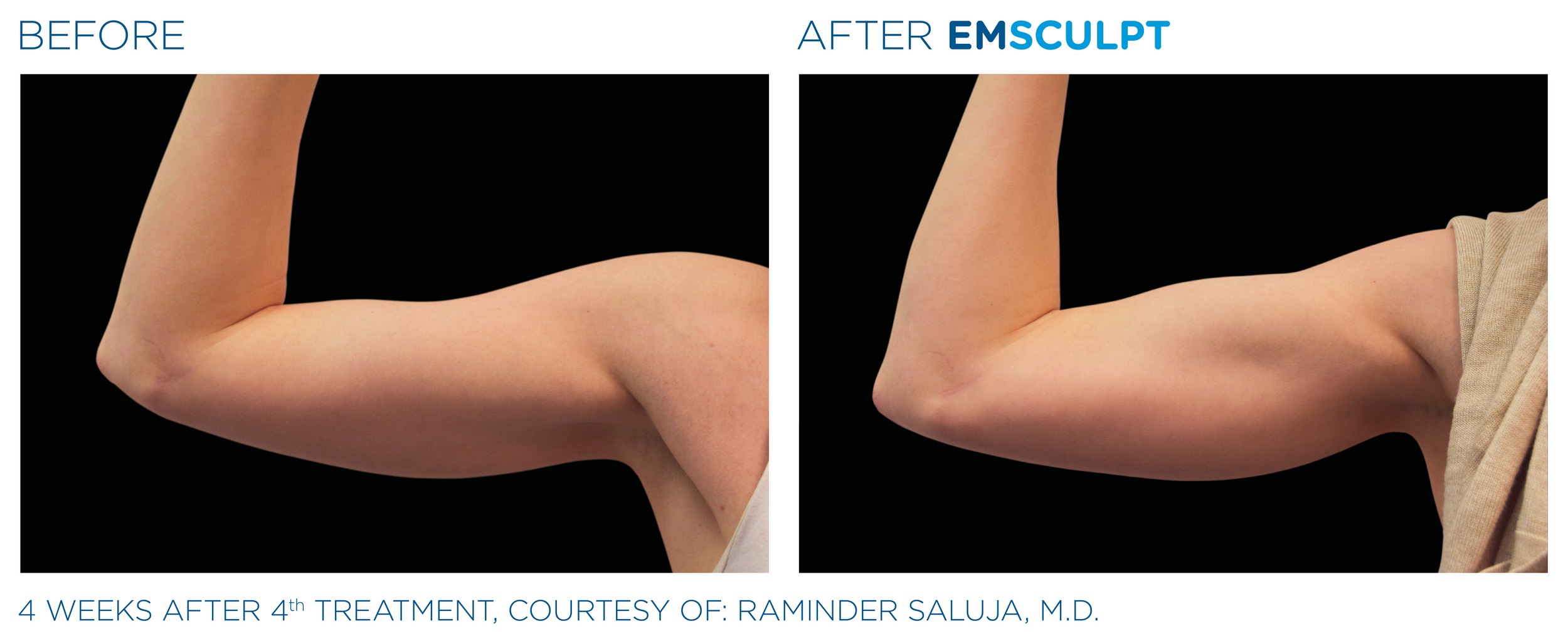Comparison of a person's upper arm before and after EMSculpt treatment showing muscle toning and reduced fat, with the 'before' side on the left and 'after' side on the right.