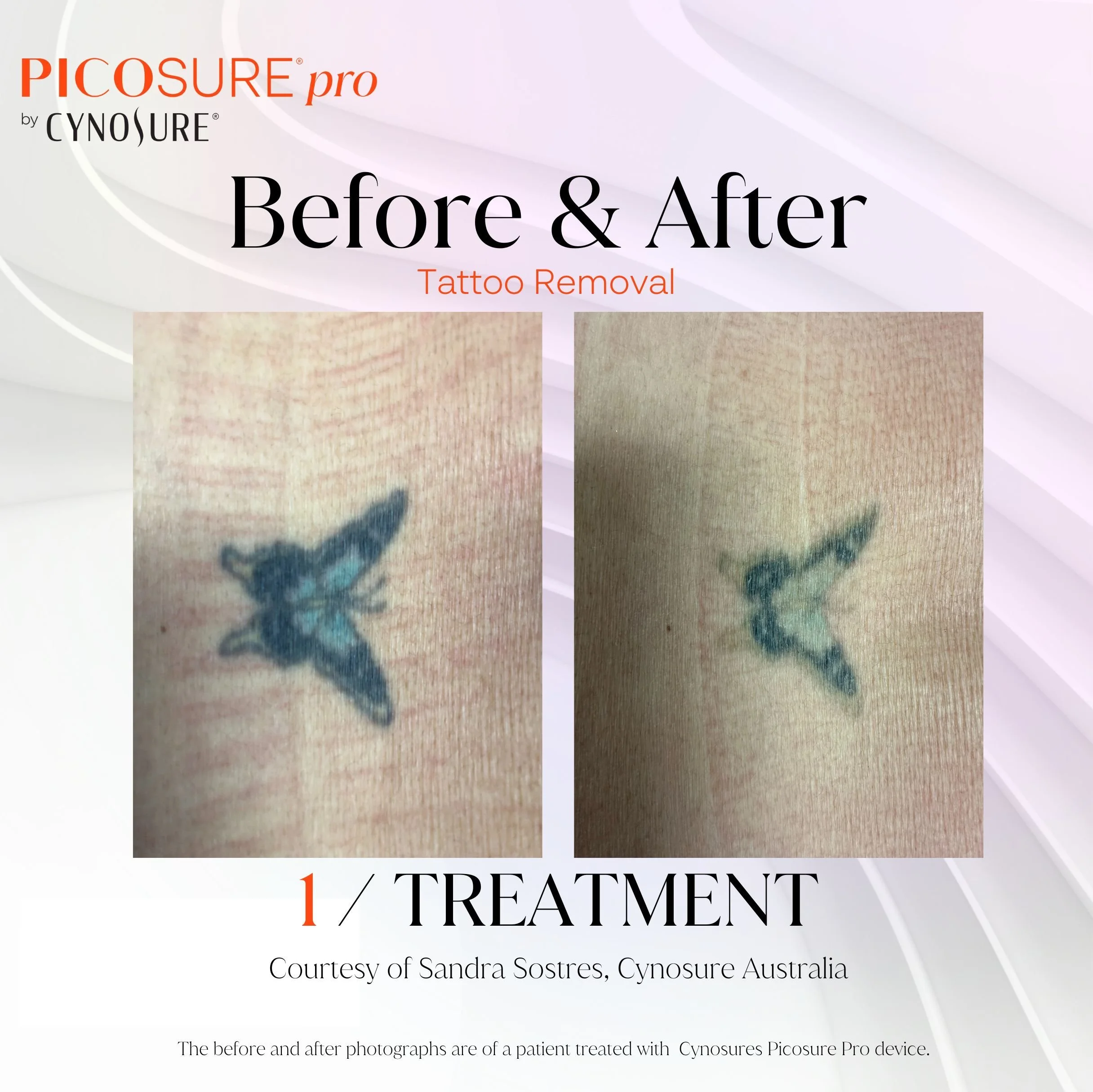 Before and after photographs of a tattoo removal, showing a small butterfly tattoo on skin. The before image displays a dark, detailed tattoo, while the after image shows faint remnants of the tattoo fading.