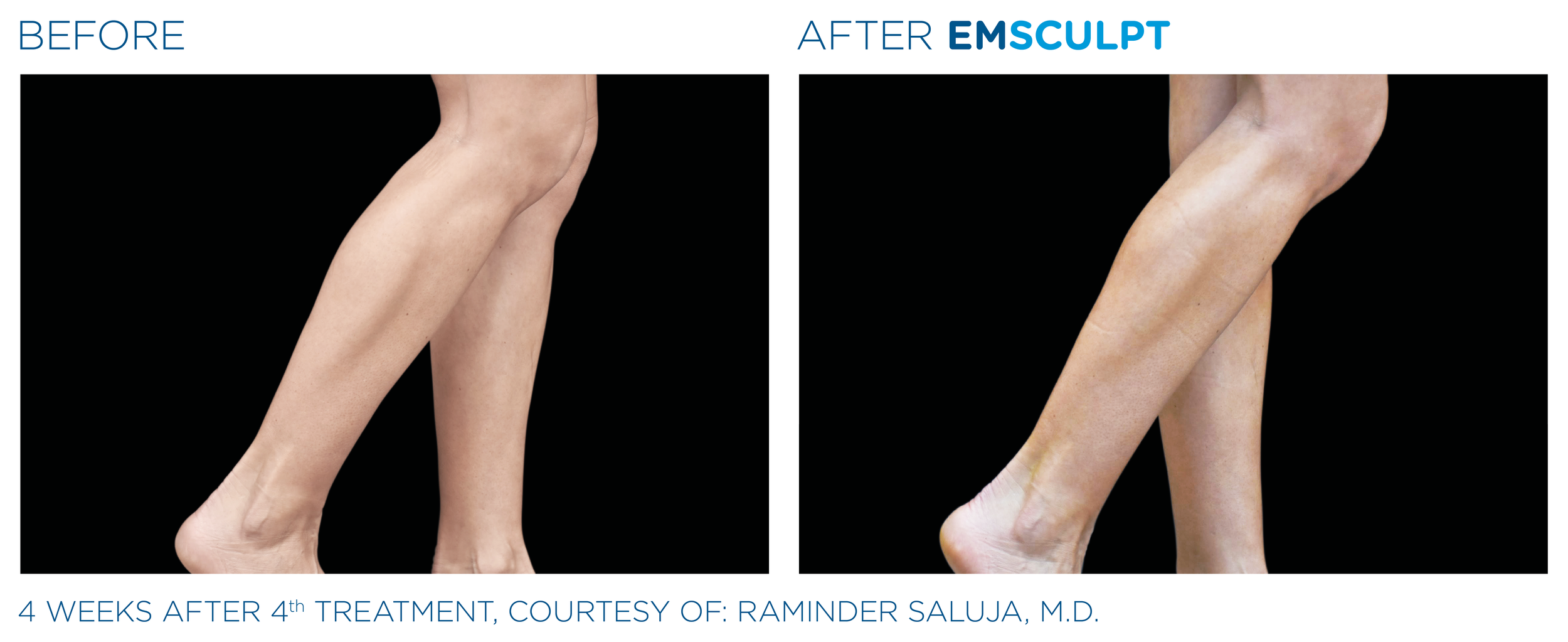 Comparison of legs before and after EMSCULPT treatment showing improved muscle tone and definition, with the after image indicating more toned legs.