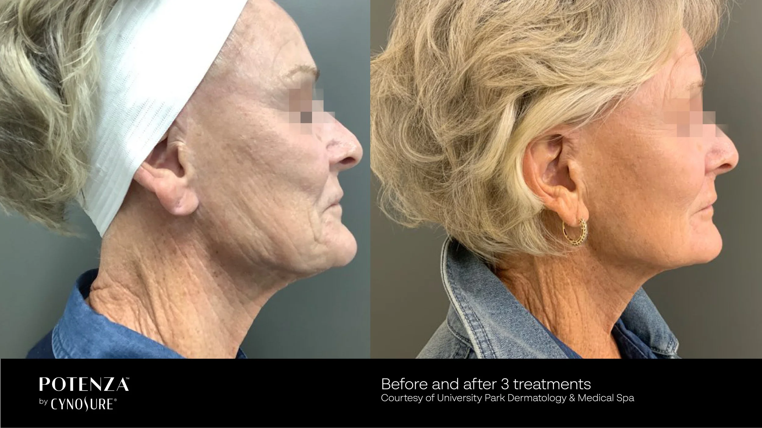 Side-by-side comparison of a woman before and after three skin treatments, showing improved skin texture and appearance. The left image depicts the woman with aged, wrinkled skin, while the right image shows smoother, younger-looking skin.