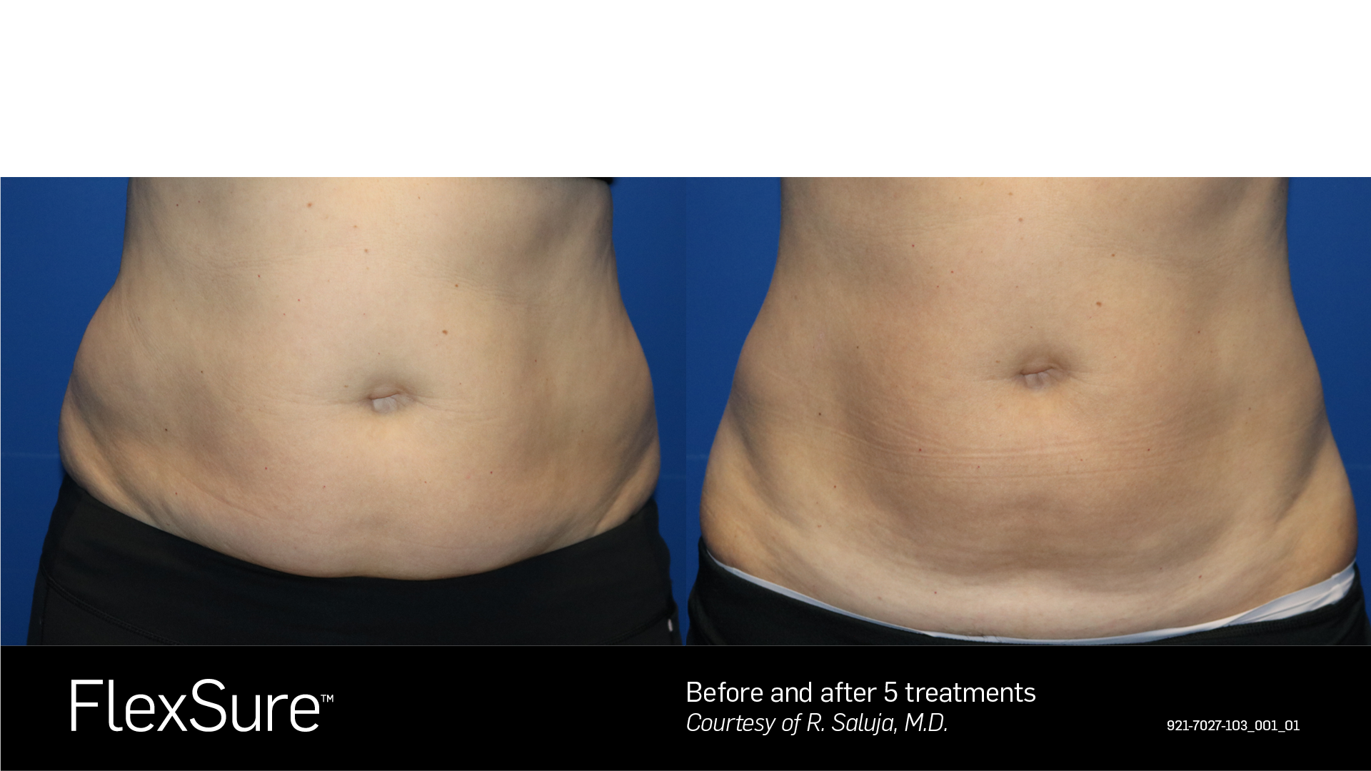 Comparison of a person's abdominal area before and after five FlexSure treatments, showing reduced abdominal fat and improved skin tightness.