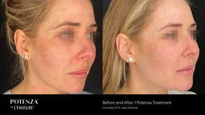 Side-by-side comparison of a woman's face showing skin improvement after a Potenza treatment, with blurred facial features for privacy.