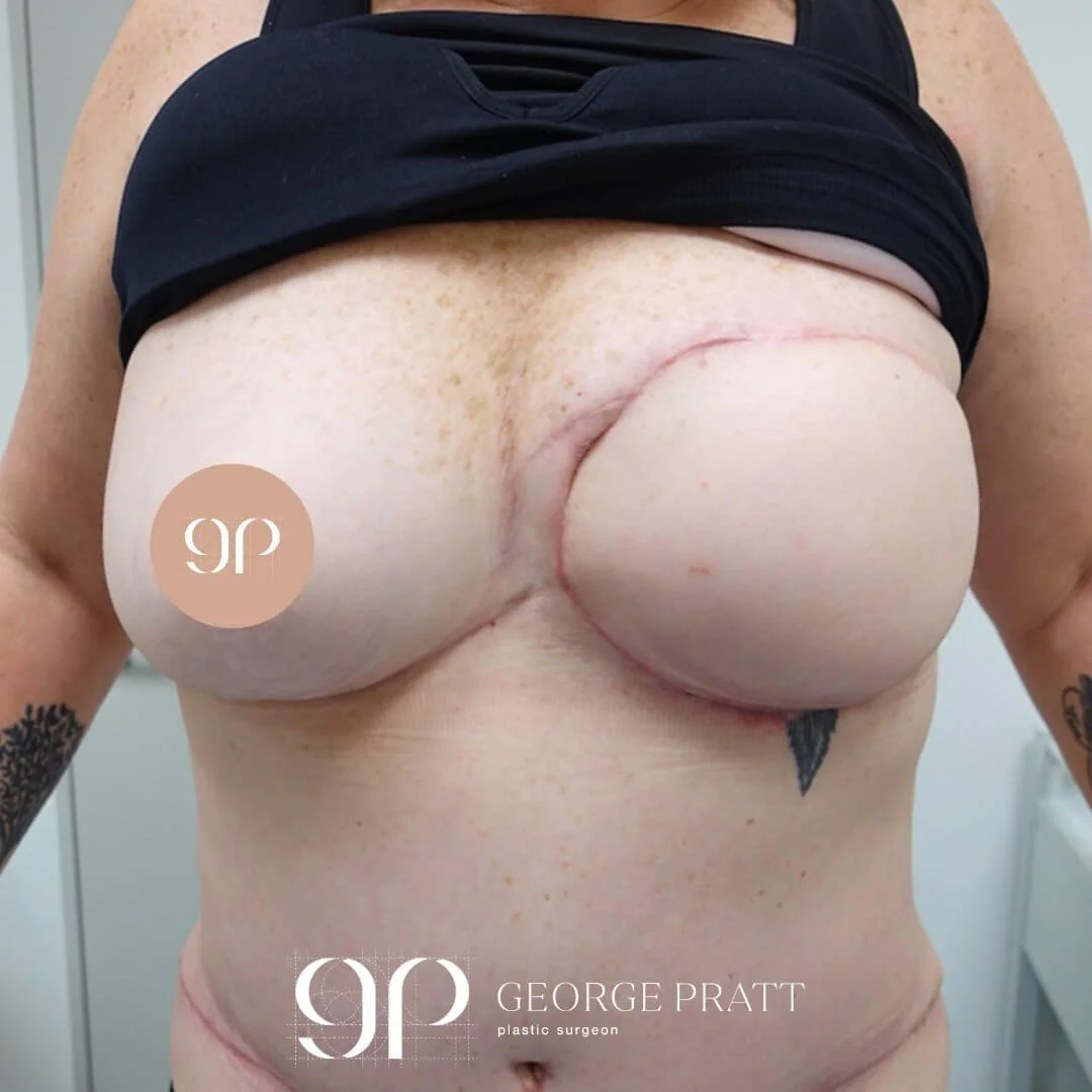 Three months after photo showing off her beautifully reconstructed breasts after surgery.