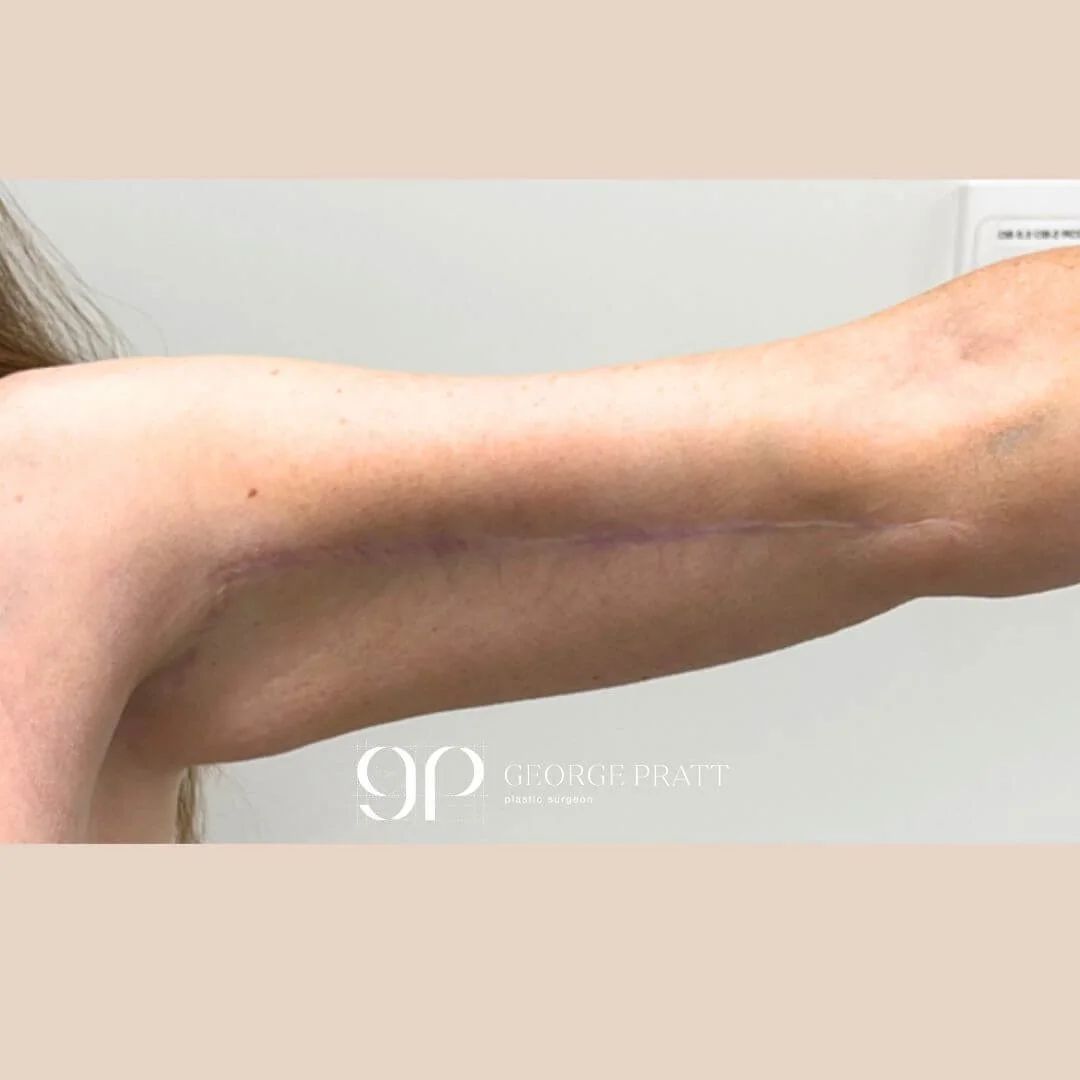 Photograph of a woman's arm, taken 18 months after arm reduction surgery