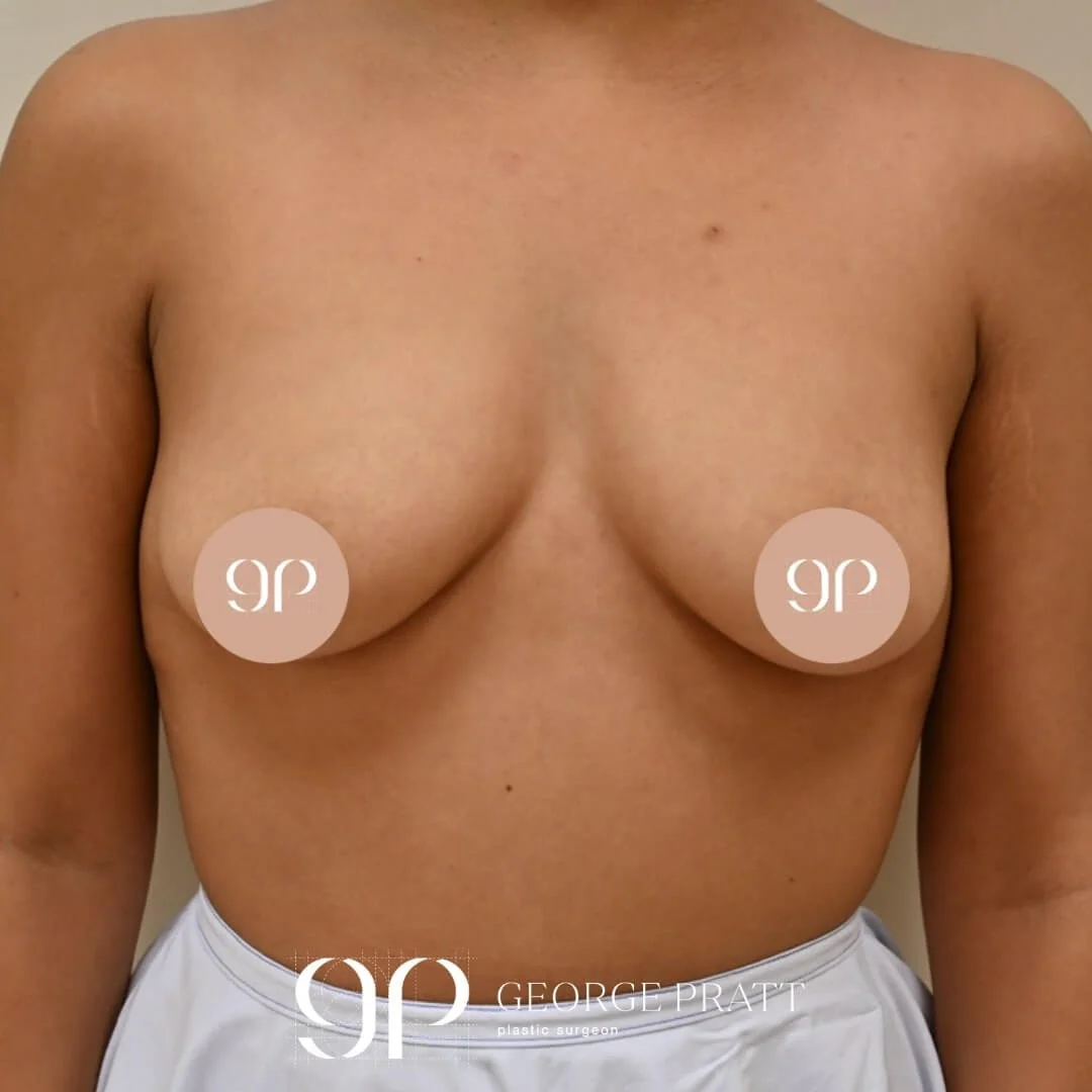 Before photo of a 33-year-od female patient, showing her natural breast size & shape prior to a breast augmentation surgery.