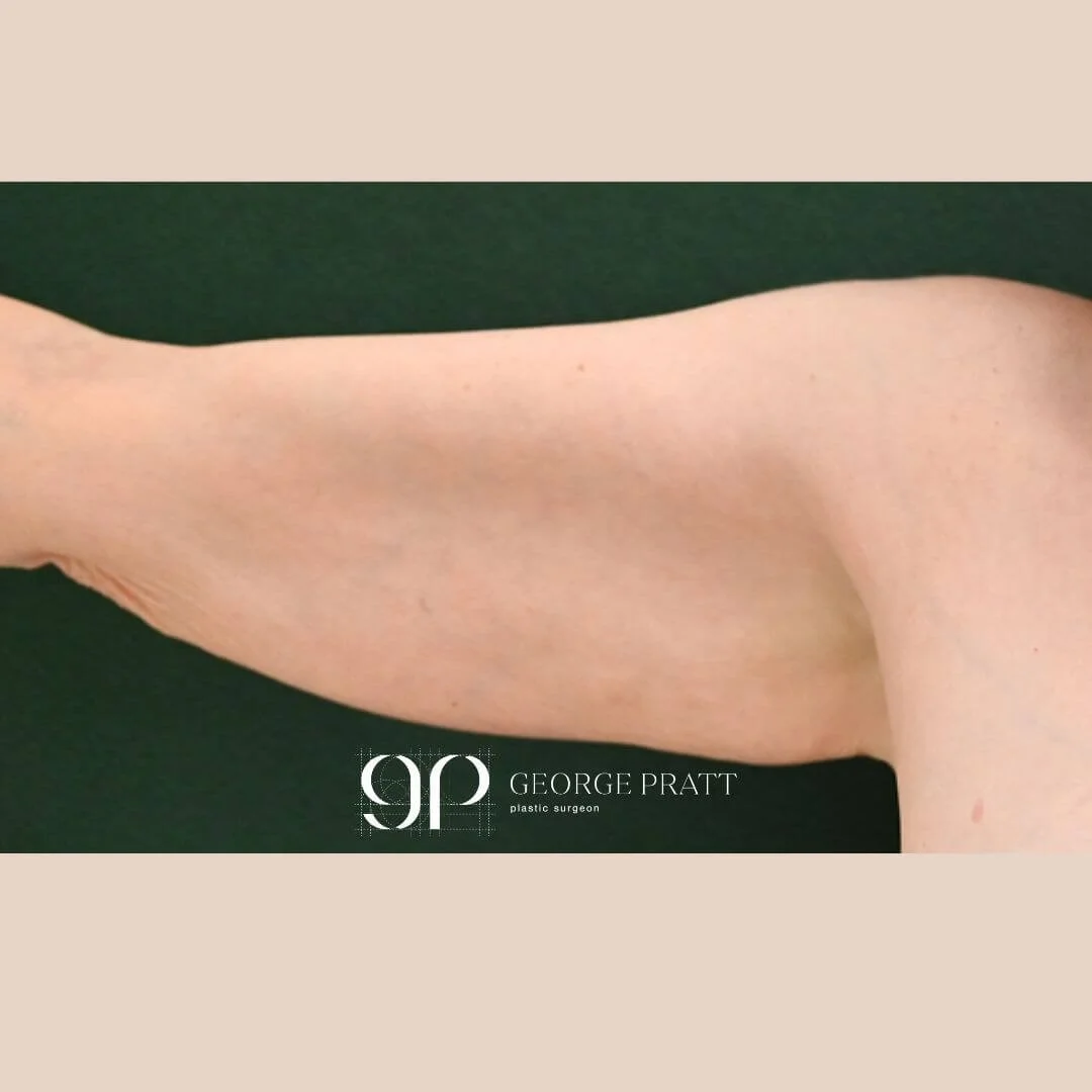Before photo of a female patient with sagging skin on her upper arm.