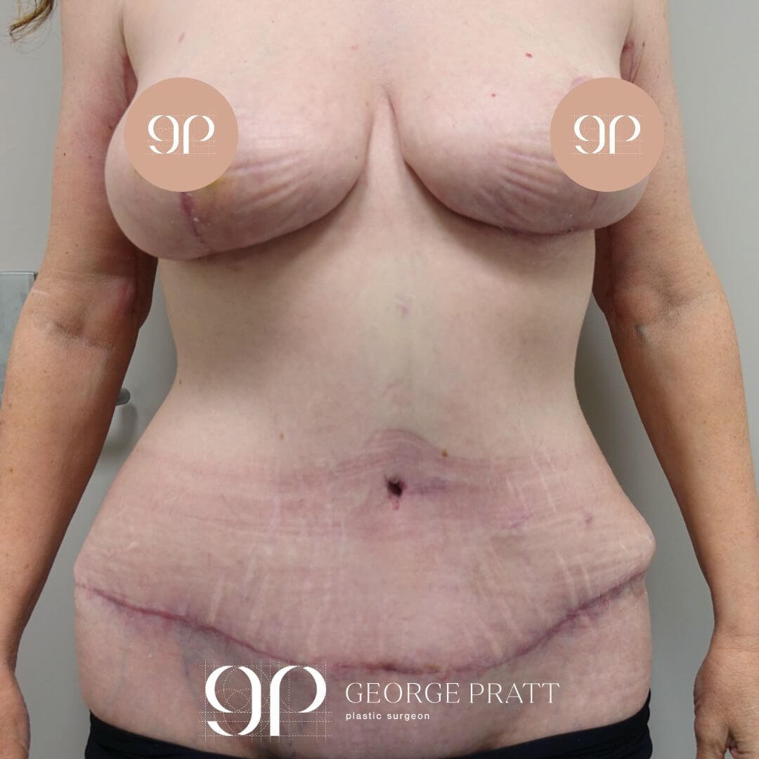 Eight weeks post-op photo of a woman's breasts after successful reduction surgery and a smoother and flatter abdominal area after tummy tuck surgery.