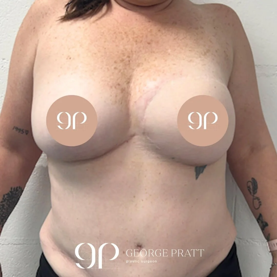 Post-operative image of a female patient's chest, 3 years after a successful breast reconstruction procedure, showcasing the natural-looking results.