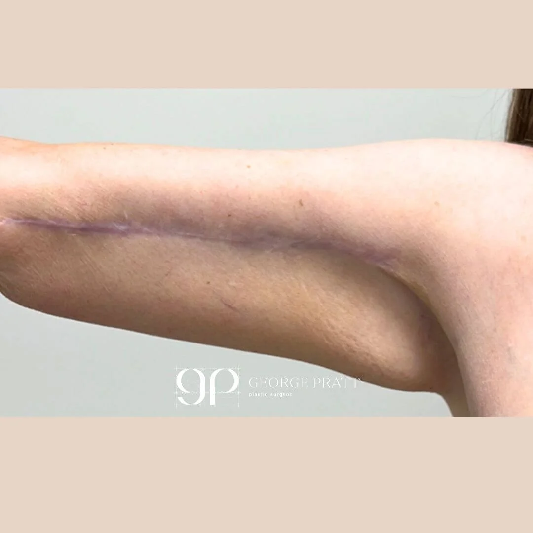 18 months post-op photo of a woman's arm, showing the positive outcome of her arm reduction surgery.