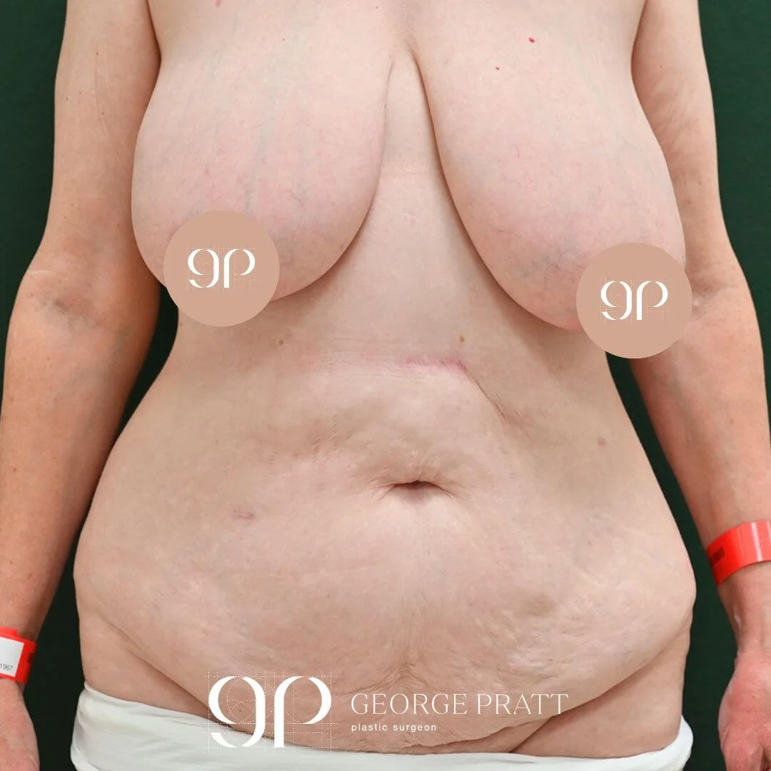 Image of a woman with large breasts and with excess belly fat before breast reduction & tummy tuck surgery