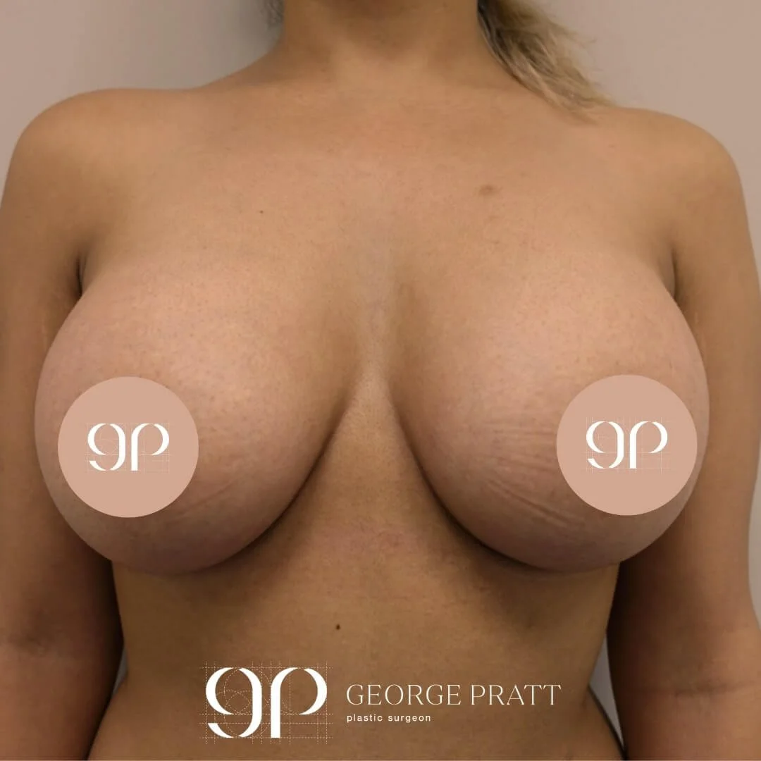 Post-operative image of a 33-year-old patient's chest, 6 weeks after a successful breast augmentation procedure.