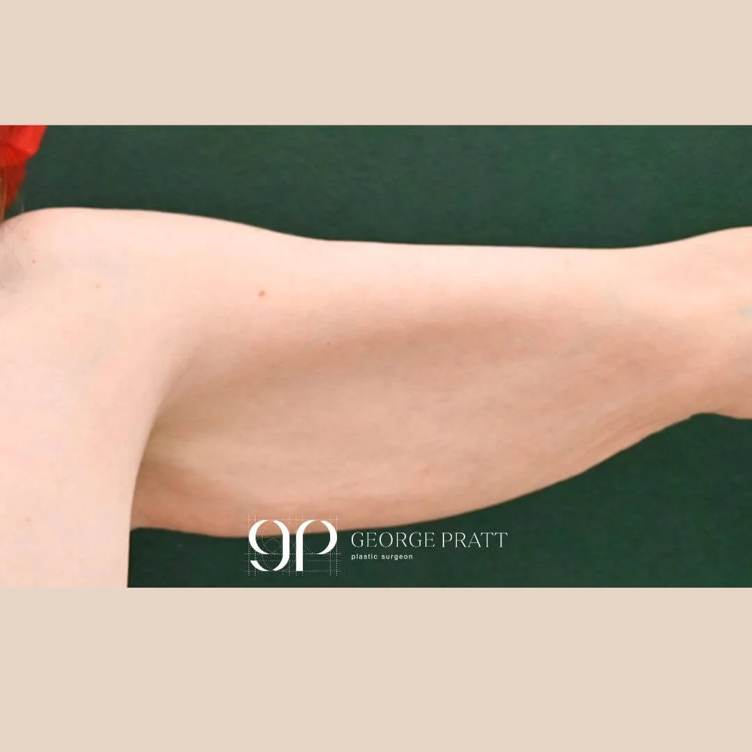 Image that captures the upper arm of a female patient, which shows loose and drooping skin.