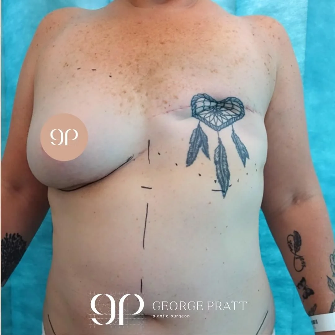 This picture shows a woman who has bravely faced a mastectomy, leaving her with no left breast. The surgical markings on her chest & abdomen as preparation for breast reconstruction surgery..