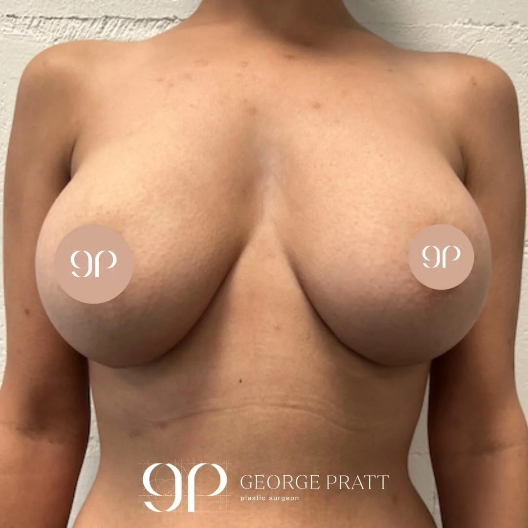 Post-operative image capturing the beautifully augmented breasts of a 33-year-old patient, 2 years after a breast augmentation surgery.