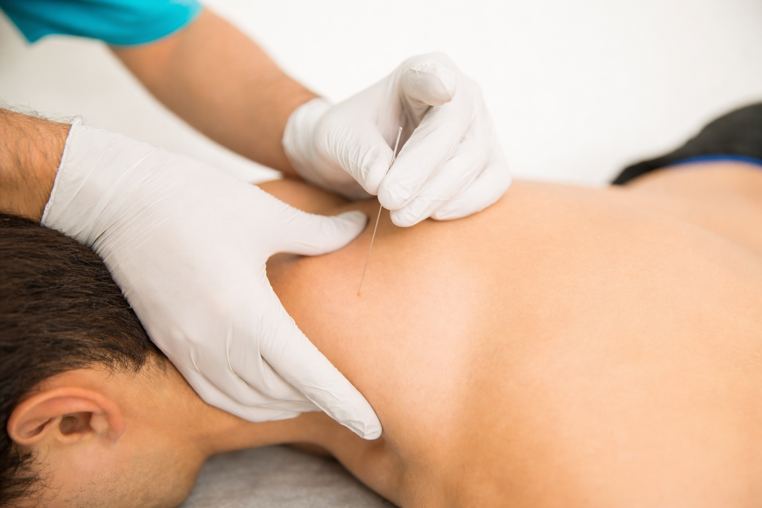 An Osteopath doing dry needling the trapezius muscle of a patient to provide relief to tight muscles