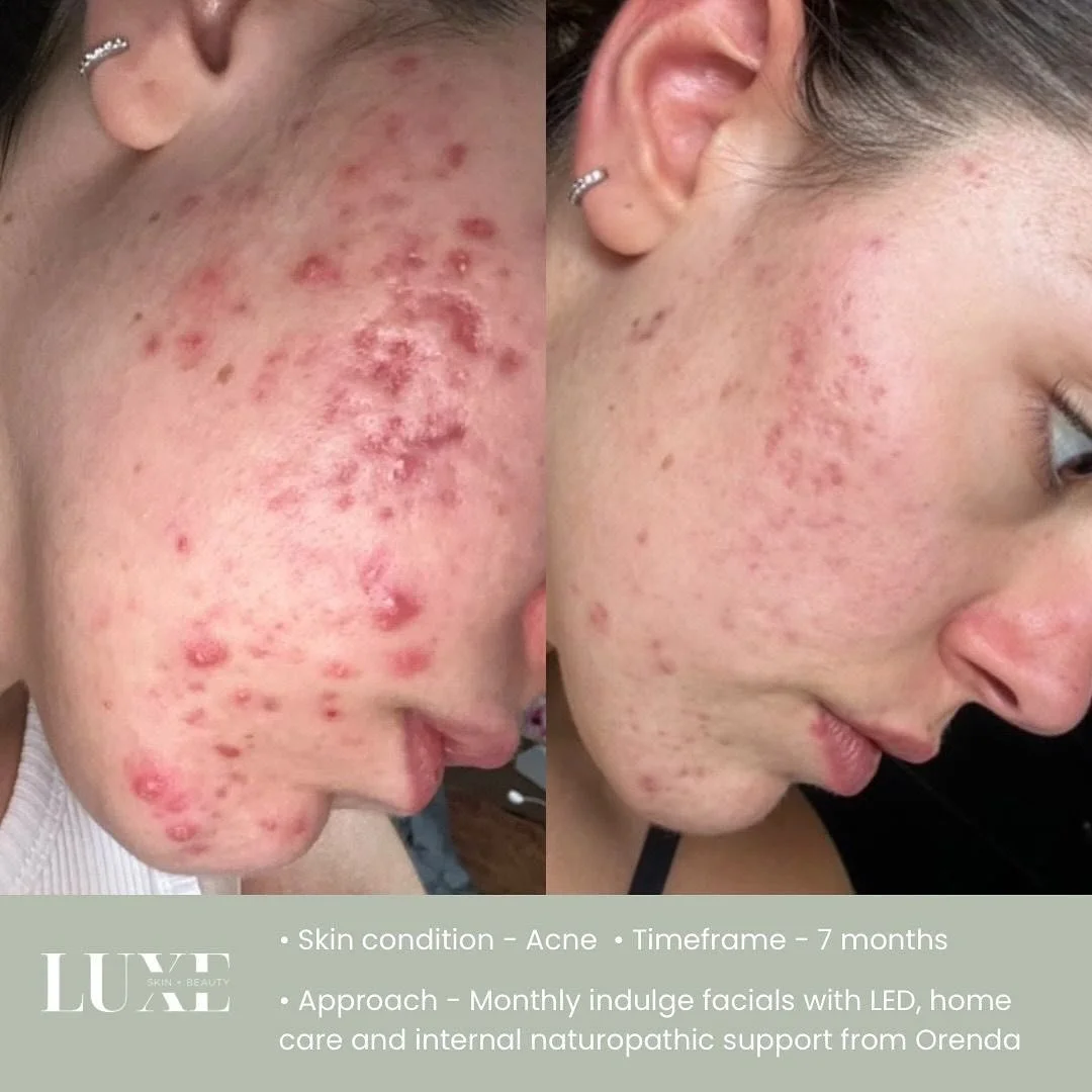 ✨ Witness the power of perseverance ✨ In just 7 months, this radiant soul transformed her skin&mdash;and her confidence&mdash;by embracing her unique journey. From battling deep, painful cystic acne for 14 years and feeling lost after prescribed roac