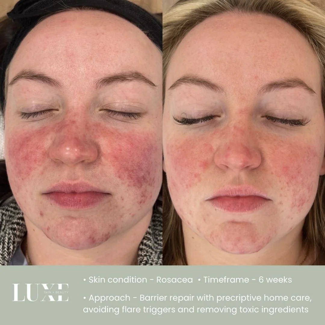 How she felt👇🏼
Our client was very inflamed, itchy, dry, flaky￼, sore cracked skin after being prescribed topical retin-a by her GP for her rosacea, making her skin much worse and uncomfortable then when she presented 😟

What we did👇🏼
We worked 