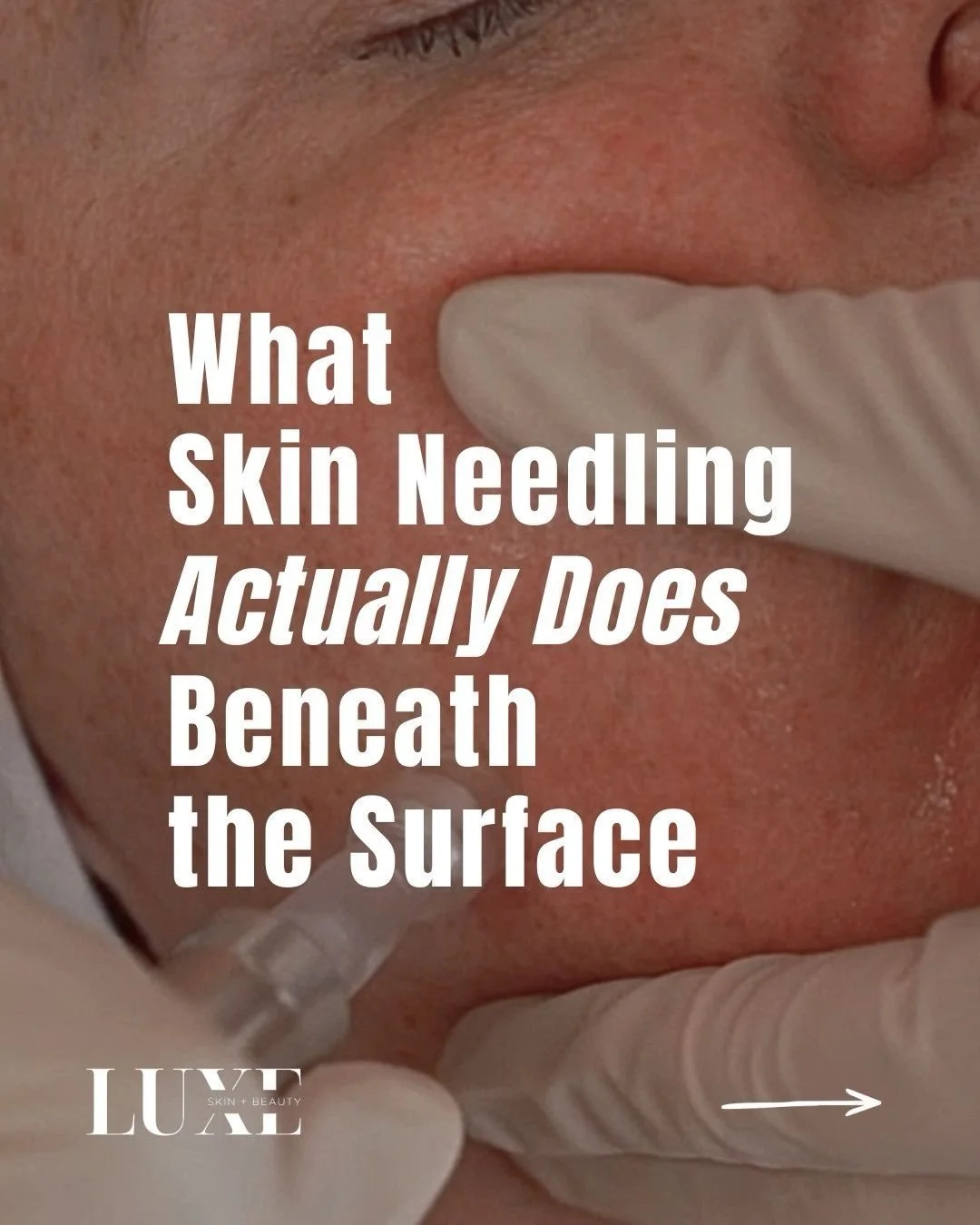 Collagen declines gradually and changes in skin structure show up as fine lines, texture irregularity, and slower healing. Skin needling encourages organised repair from the inside out. 

Over the next few weeks, we&rsquo;ll explore who it&rsquo;s su