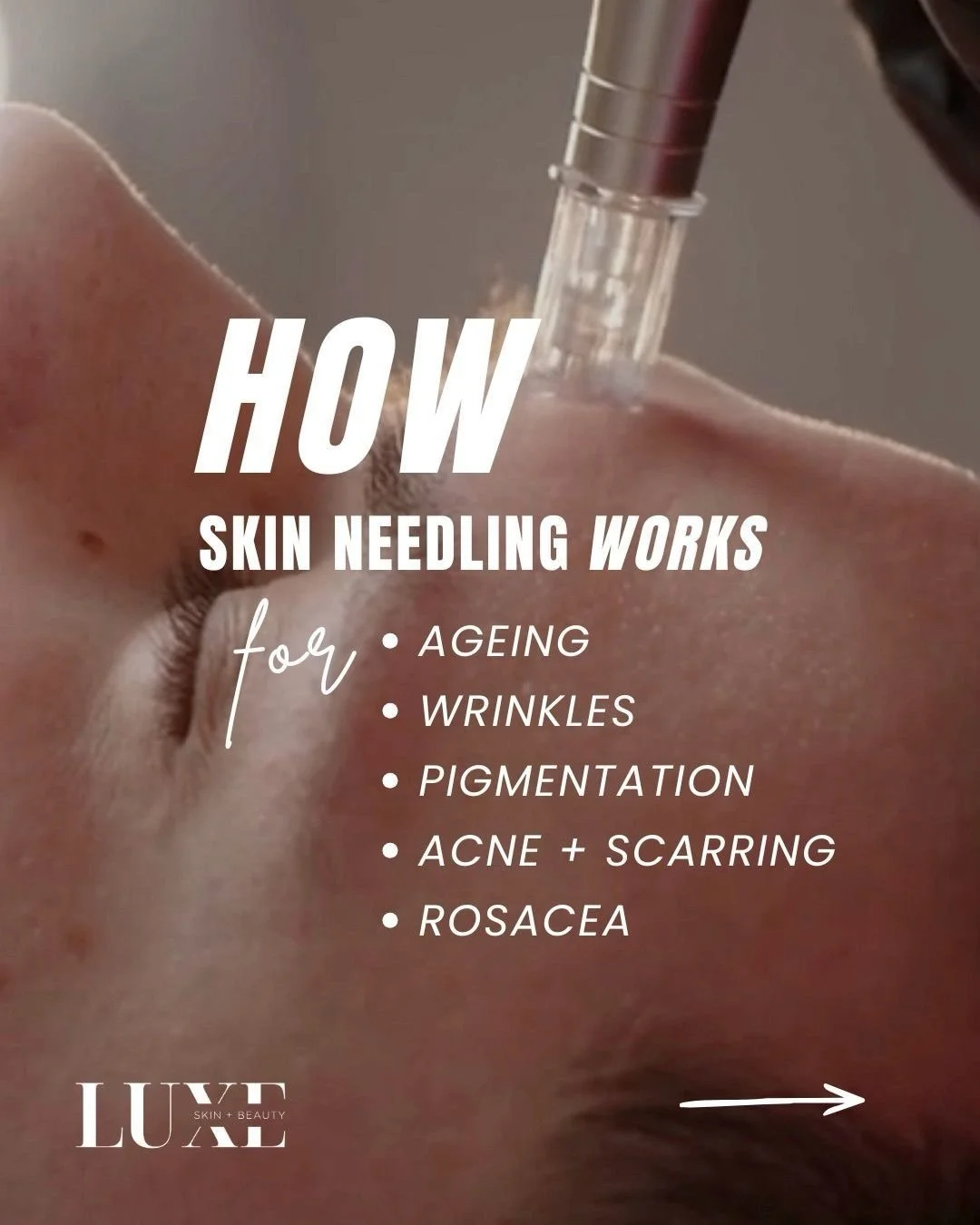 Understanding how skin needling works on your individual skin condition empowers you to make educated treatment decisions that are right for you and your skin, not because it was suggested by an influencer who doesn&rsquo;t even know your name 🙈

He