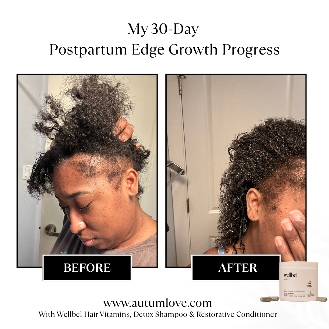 How I Finally Started Growing My Postpartum Edges Back After 3 Years