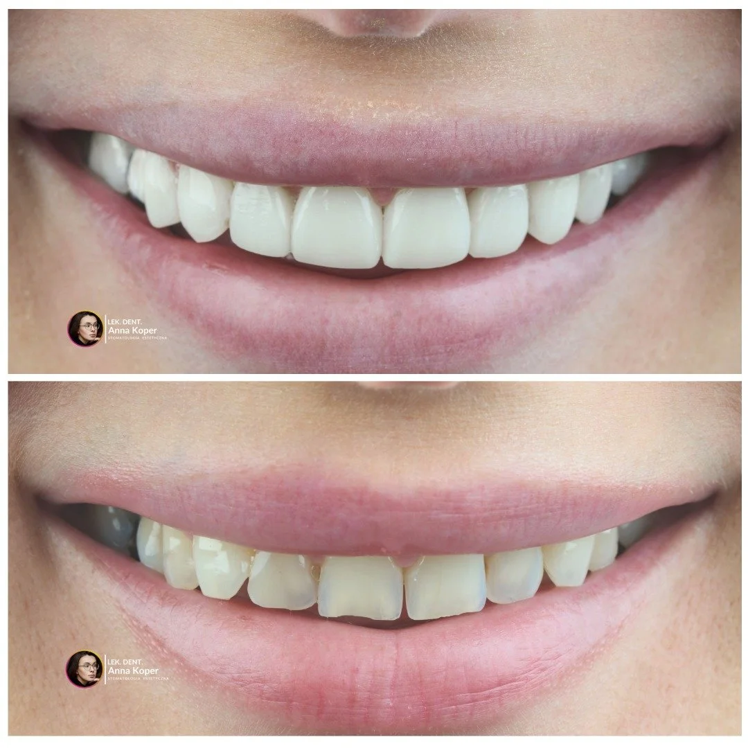 Uśmiech to naturalne lekarstwo.🦷
Obniża poziom stresu, wzmacnia odporność i poprawia samopoczucie &ndash; Twoje i os&oacute;b wok&oacute;ł Ciebie.
#estiface #dentystakoper #bondingsiedlce #dentystasiedlce