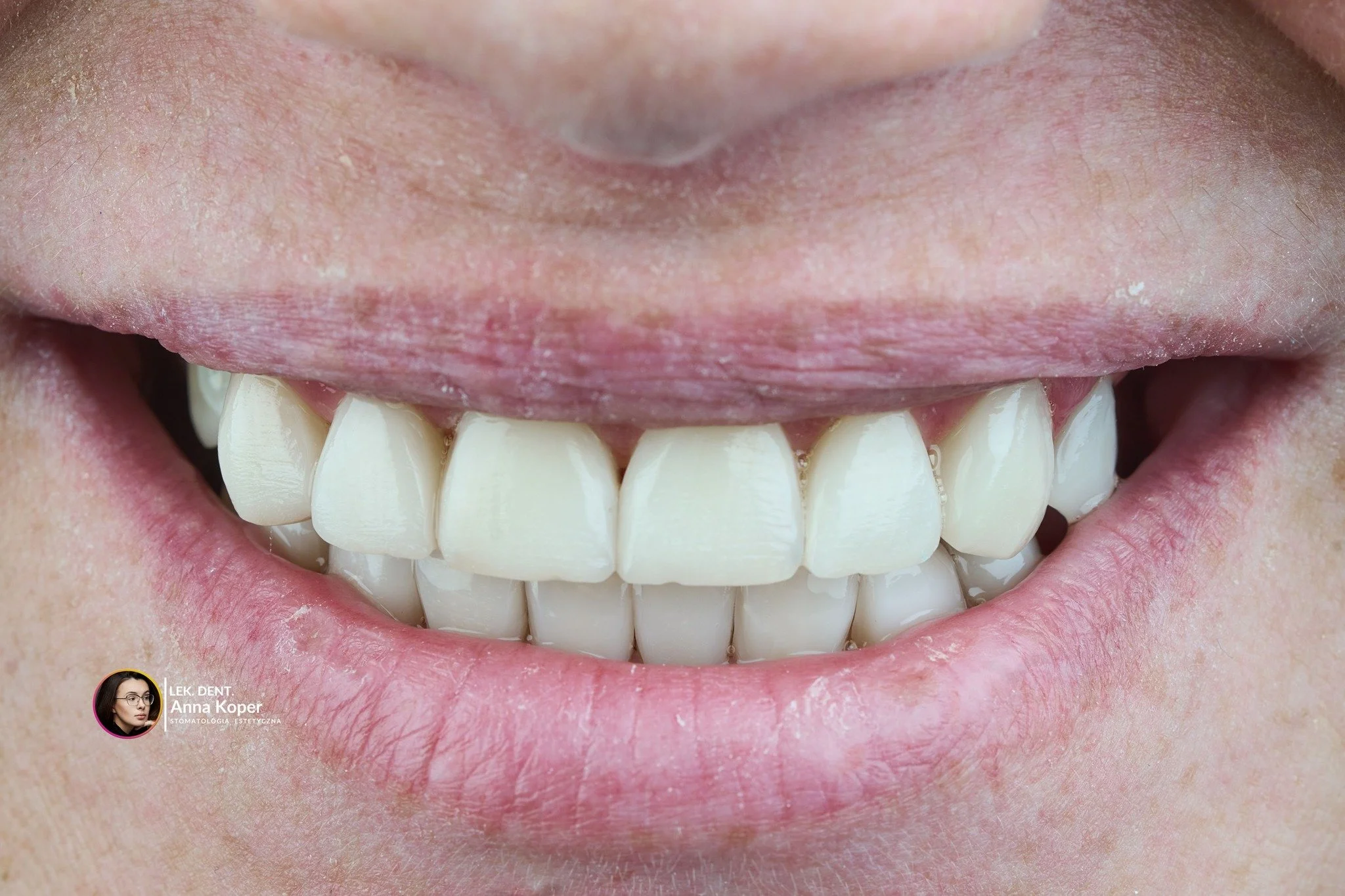 Kompleksowo, ale małoinwazyjnie &ndash; tak właśnie lubimy pracować w Estiface 💫

Dzięki nowoczesnym materiałom kompozytowym możemy odbudować cały uśmiech, zachowując maksymalnie naturalne tkanki zęba.
Bez agresywnego szlifowania, bez b&oacute;lu &m