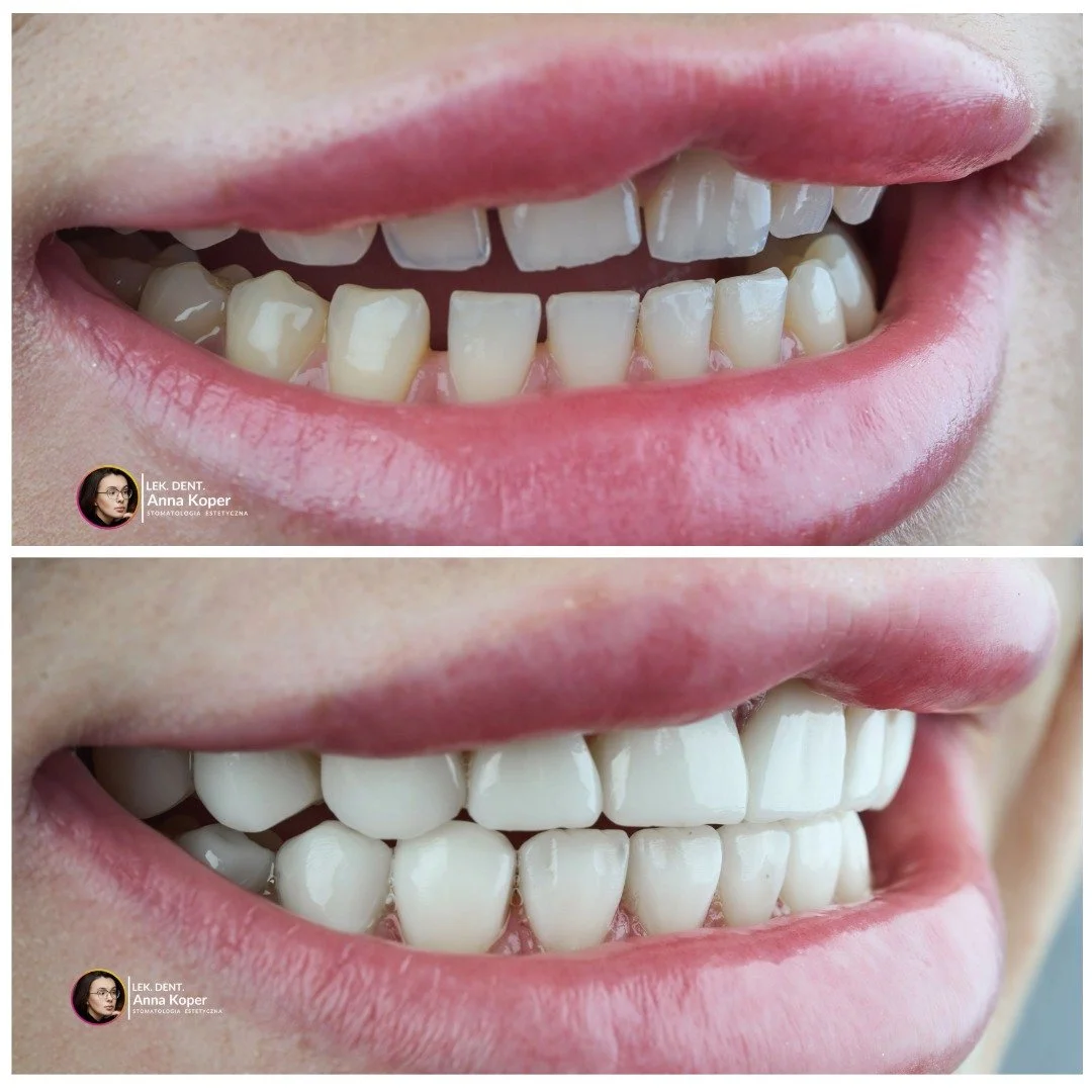 Czy wiesz, że bonding to rękodzieło ...✨

Każdy uśmiech powstaje warstwa po warstwie, jak małe dzieło sztuki.
Nie kopiujemy uśmiech&oacute;w. Każdy ząb modelujemy indywidualnie, dopasowując kolor, kształt i proporcje do całej twarzy.

To nie szybki z