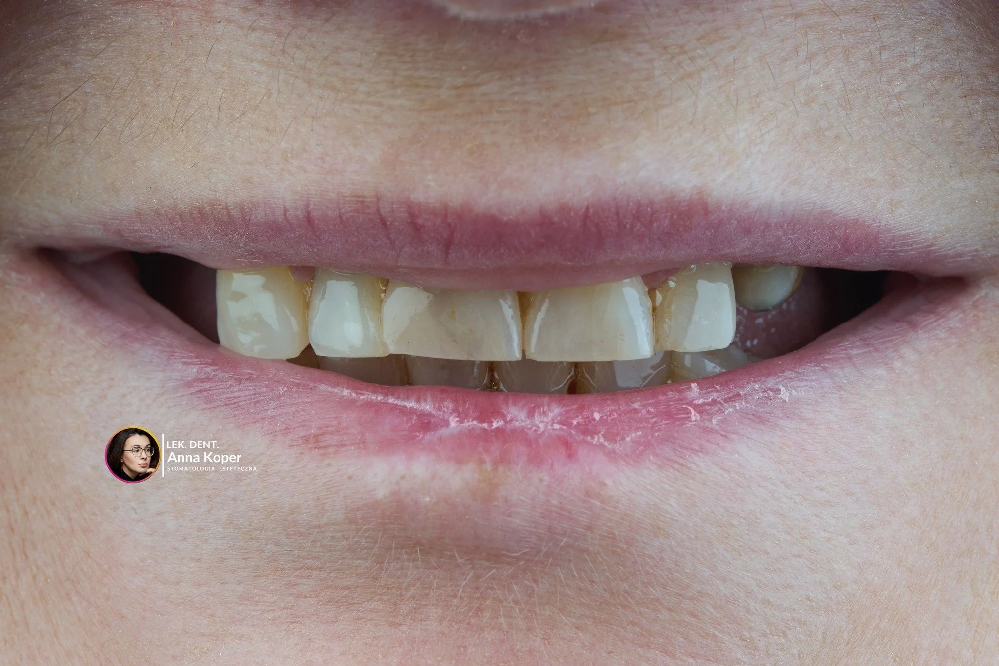 ✨ Anti-aging zaczyna się od uśmiechu ✨Zadbany, harmonijny uśmiech potrafi odmłodzić bardziej niż niejeden zabieg! 😍
To właśnie od niego zaczyna się prawdziwe anti-aging &ndash; bo zdrowe i proporcjonalne zęby nadają twarzy świeżości, lekkości i młod