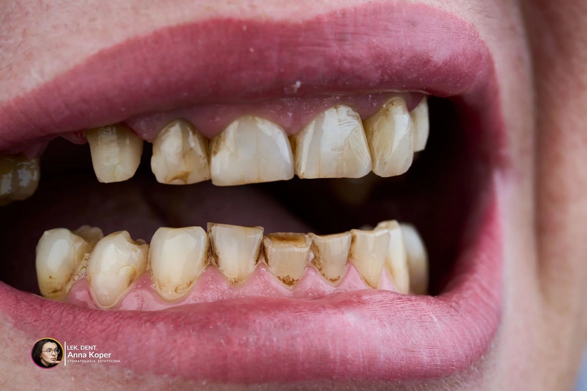 ✨ Metamorfoza uśmiechu to coś więcej niż estetyka
Dziś zęby to nie tylko funkcja &ndash; to część wizerunku, pewności siebie i osobowości.
Uśmiech potrafi odmienić nie tylko twarz, ale i to, jak czujemy się każdego dnia.

Każda metamorfoza to indywid