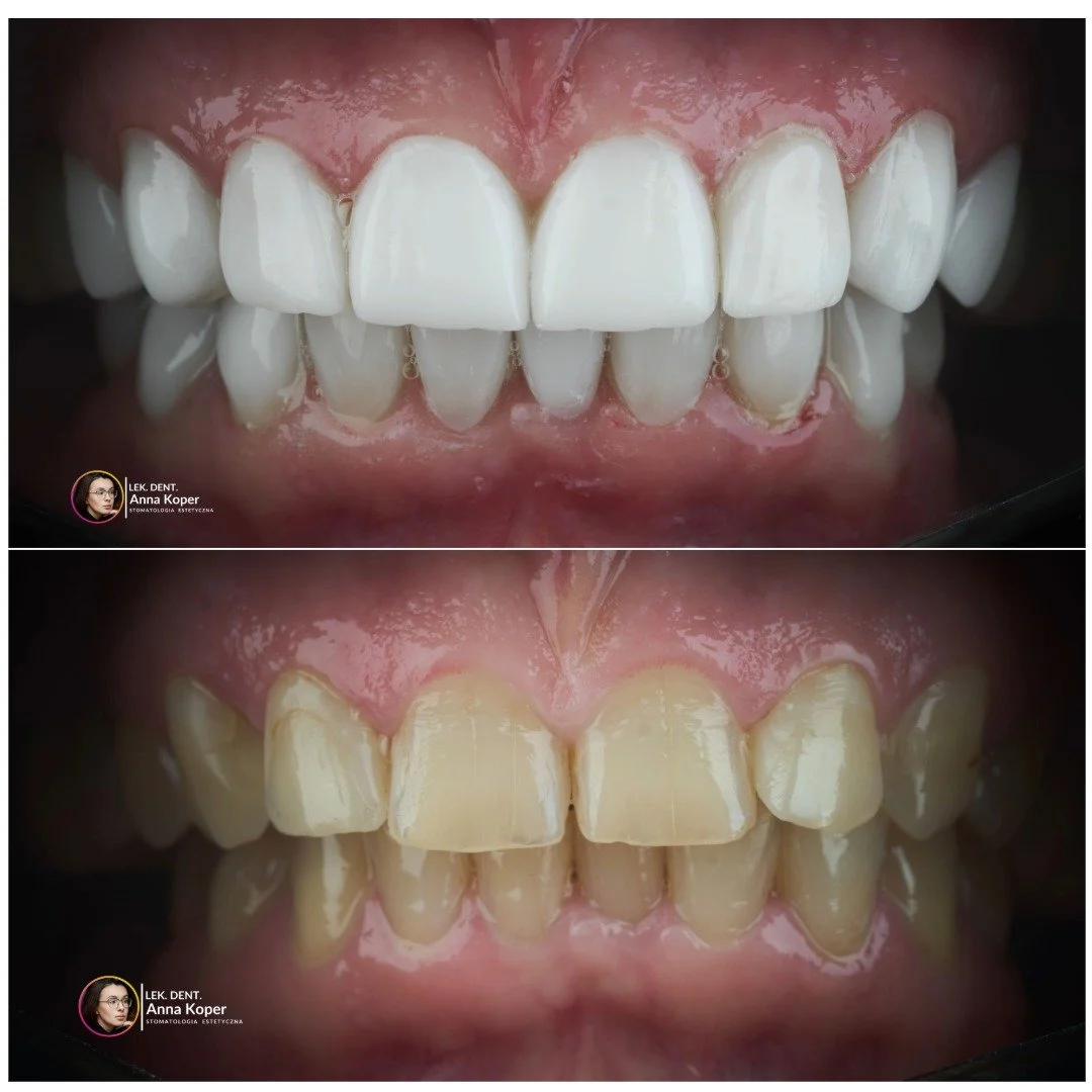 Nowy uśmiech. Nowa pewność siebie. 💫
Czasem zmiana zaczyna się od jednego spojrzenia w lustro.
Zęby, kt&oacute;re kiedyś były jasne i r&oacute;wne, z biegiem lat tracą sw&oacute;j blask, ścierają się, matowieją.
A przecież uśmiech to nasza wizyt&oac