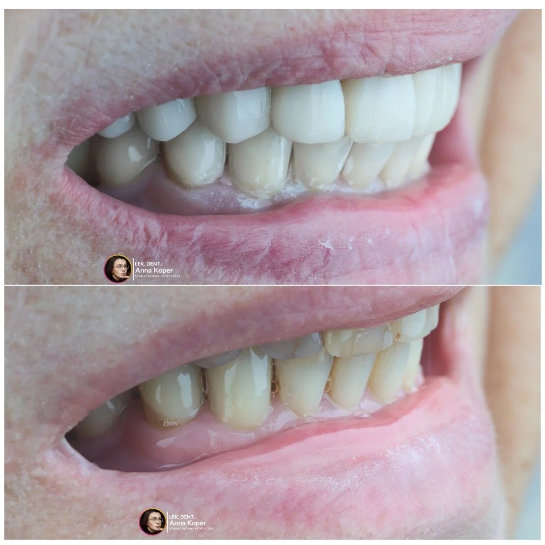 Piękny uśmiech nie ma wieku. 💫
Ta metamorfoza pokazuje, że o estetykę można zadbać w każdym momencie życia.
Delikatna odbudowa, jasny kolor i naturalny kształt &ndash; tyle wystarczy, by zn&oacute;w uśmiechać się z pewnością siebie. 🤍

📍 Estiface 