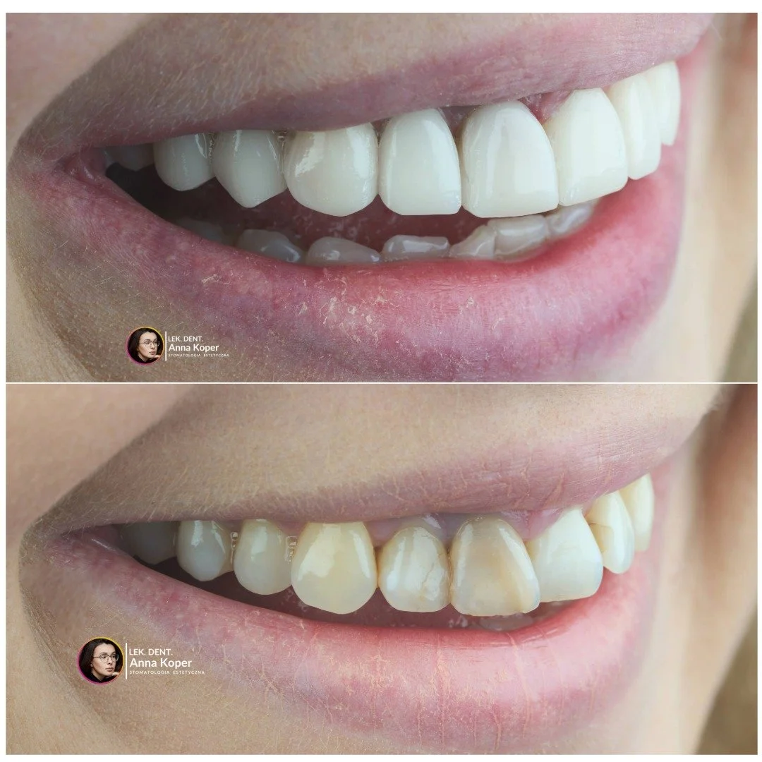 Zostało coraz mniej czasu, by olśnić uśmiechem w Nowym Roku! ✨
Jeśli marzysz, by przywitać Nowy Rok z pewnością siebie i pięknym, promiennym uśmiechem &ndash; to ostatni moment, by um&oacute;wić się na metamorfozę. ⏰

Terminy przed końcem roku topnie