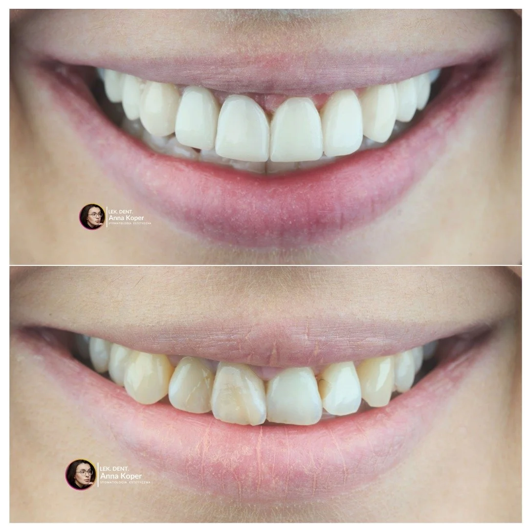 Każdy z nas pragnie czuć się pewnie i komfortowo w swoim wyglądzie, a uśmiech to jeden z najważniejszych element&oacute;w, kt&oacute;ry wpływa na to, jak postrzegają nas inni. Zadbane, zdrowe zęby to nie tylko efekt zdrowia jamy ustnej, ale także nas