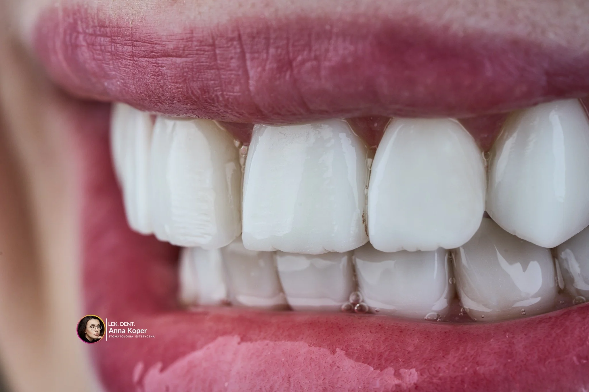Bonding to nie tylko &ldquo;założenie kompozytu&rdquo;. To precyzyjna, ręczna praca, w kt&oacute;rej każdy milimetr ma znaczenie.

To właśnie wykończenie i detale decydują, czy ząb wygląda naturalnie, czy &bdquo;zrobiony&rdquo;.
To:
🔹 delikatna prze