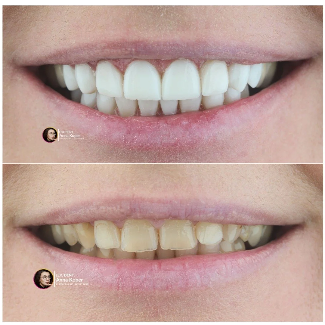 🕵👑Kiedy uśmiech zaczyna pasować do Ciebie&hellip;

Nie każdy uśmiech potrzebuje rewolucji.
Czasem wystarczy precyzyjna odbudowa kompozytowa, dopracowana warstwa po warstwie, żeby twarz odzyskała lekkość i świeżość.

Na zdjęciu ⏬ widać dokładnie, ja