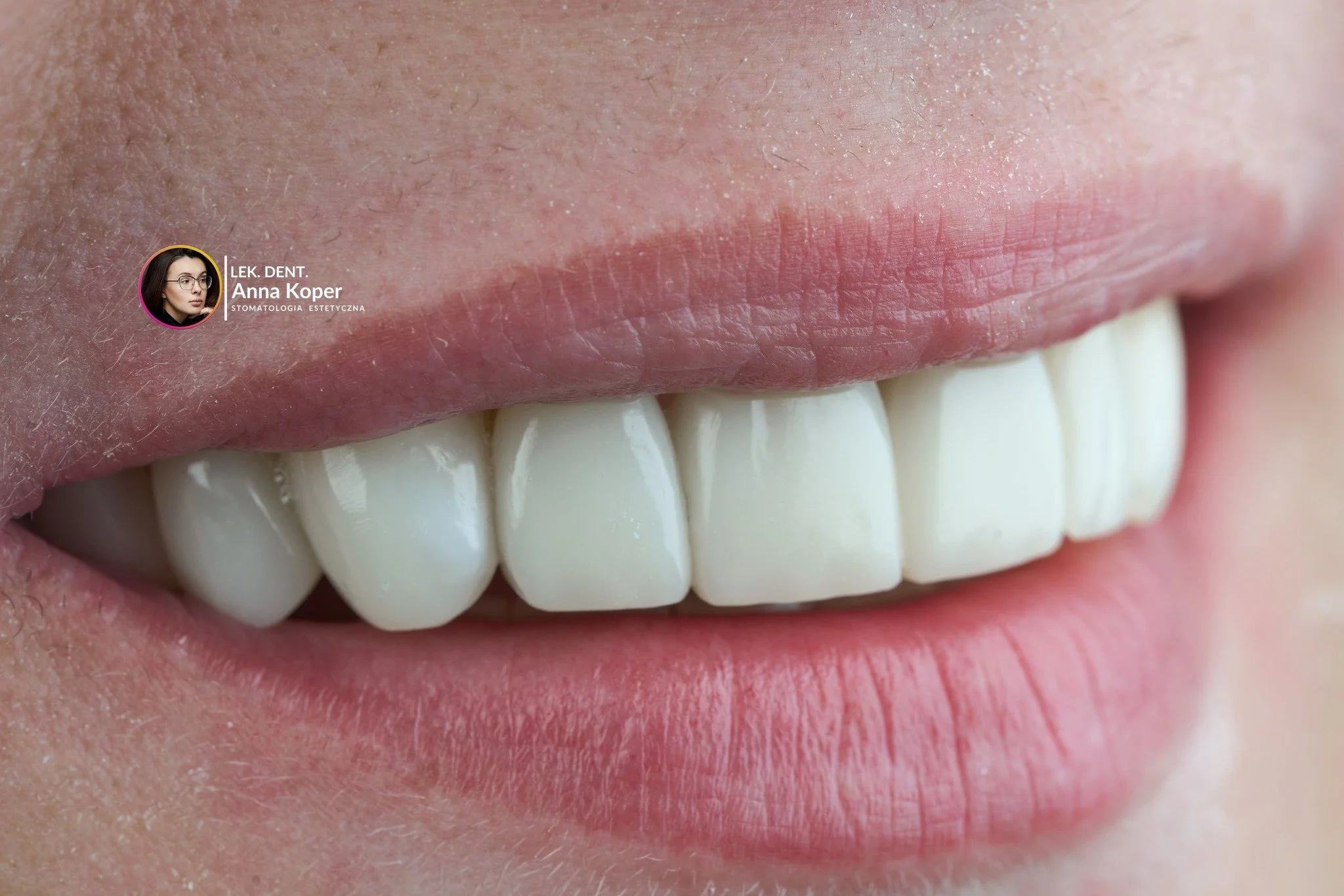 Gdy patrzę na wszystkie metamorfozy wykonane w Estiface w 2025 roku &mdash; te małe, subtelne korekty i te pełne, spektakularne przemiany &mdash; czuję ogromną wdzięczność.
Każdy z tych uśmiech&oacute;w to osobna opowieść, indywidualna droga i chwila