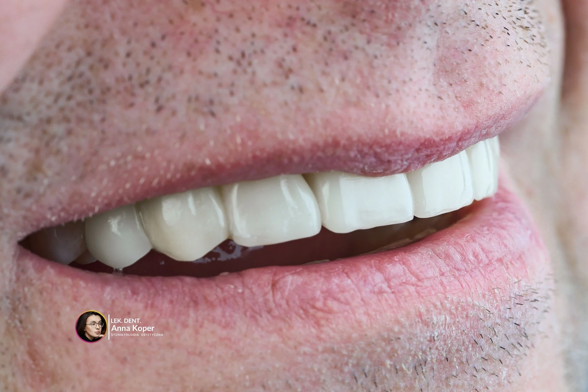 🎄✨ Metamorfoza, kt&oacute;ra pokazuje, że męsko znaczy&hellip; zadbanie ✨🎄

Uśmiech to nie tylko detal.
To część pierwszego wrażenia, pewności siebie, sposobu, w jaki wchodzimy w rozmowy &mdash; w pracę, relacje, codzienność.

Na załączonych zdjęci