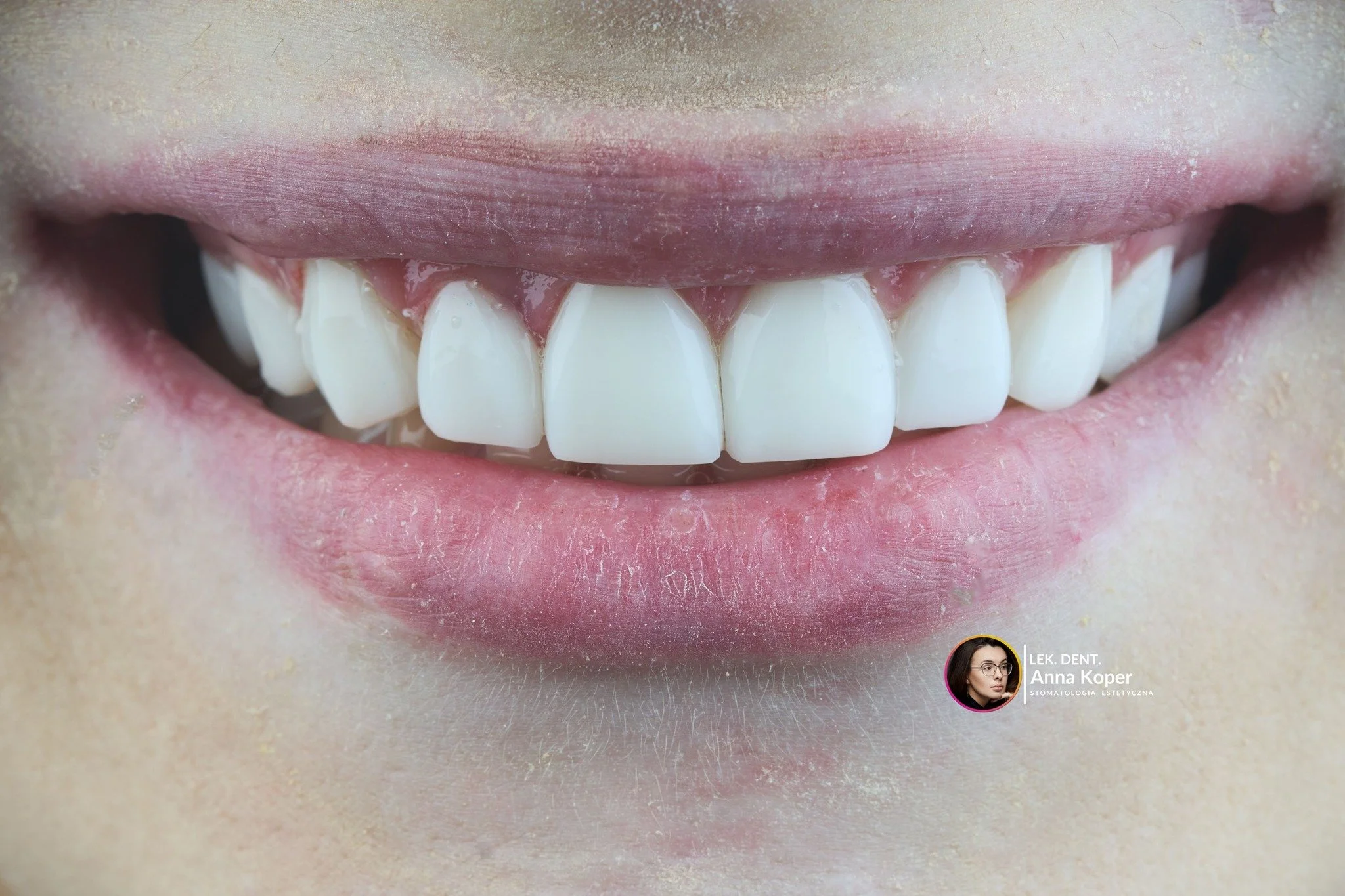 Przed świętami często zatrzymujemy się na chwilę.
Patrzymy w lustro trochę uważniej, z myślą o spotkaniach, rozmowach, uśmiechach przy stole.

Te metamorfozy powstały spokojnie, z dbałością o detal i naturalność.
Bez pośpiechu &mdash; tak, aby uśmiec