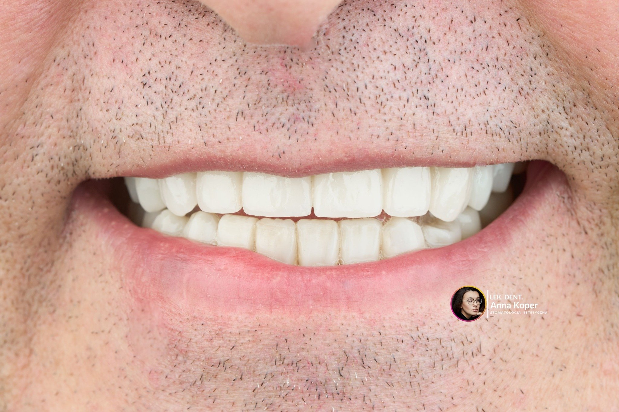 Nowy Rok, nowa energia, piękne uśmiechy &ndash; witamy 2026 w Estiface 🤍🦷
Święta za nami, powoli wracamy do codzienności &ndash; a w Estiface zaczynamy Nowy Rok tak, jak lubimy najbardziej ✨
Od spektakularnej metamorfozy uśmiechu, kt&oacute;ra poka