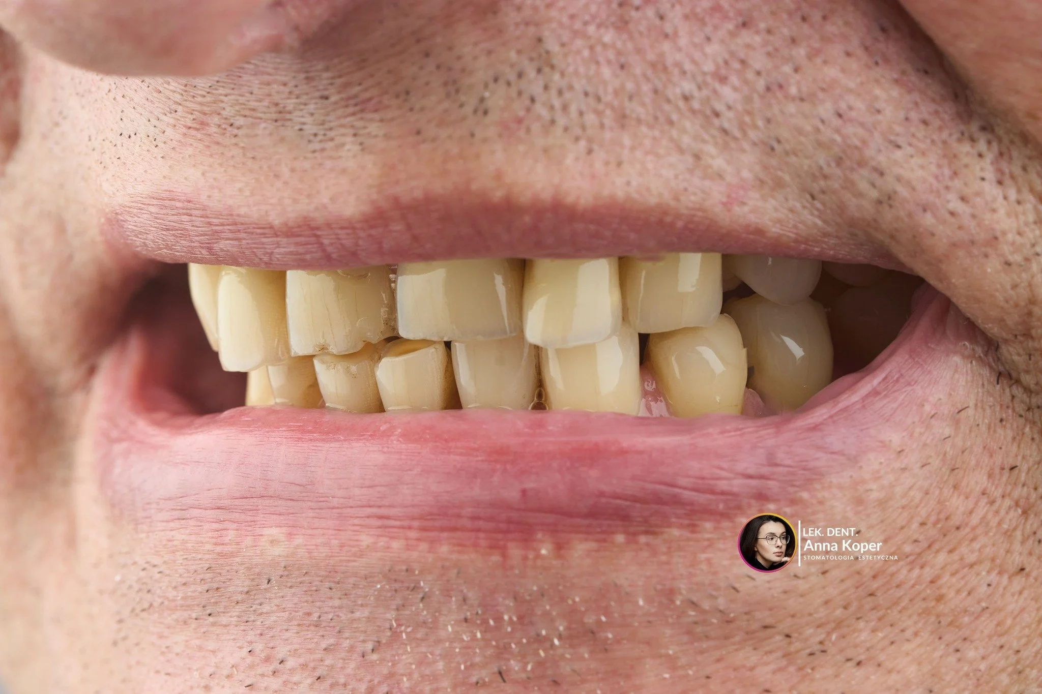 Jeśli zastanawiasz się, czy warto leczyć zęby &ndash; pamiętaj, że nie chodzi wyłącznie o wygląd. 

Czasem decyzja o leczeniu zęb&oacute;w nie wynika z estetyki.
Częściej zaczyna się od dyskomfortu, zmęczonego uśmiechu, poczucia, że &bdquo;coś jest n