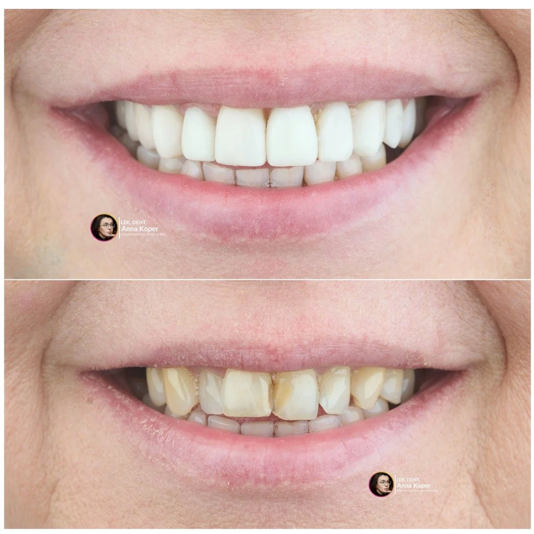 Sp&oacute;jrzcie na tę cudowną zmianę! 📸 To nie tylko kolejna wykonana praca w naszym gabinecie &ndash; to historia o odzyskaniu swobody w śmianiu się &bdquo;od ucha do ucha&rdquo;.

Bardzo często pytacie nas: &bdquo;Czy u mnie też da się coś zrobić