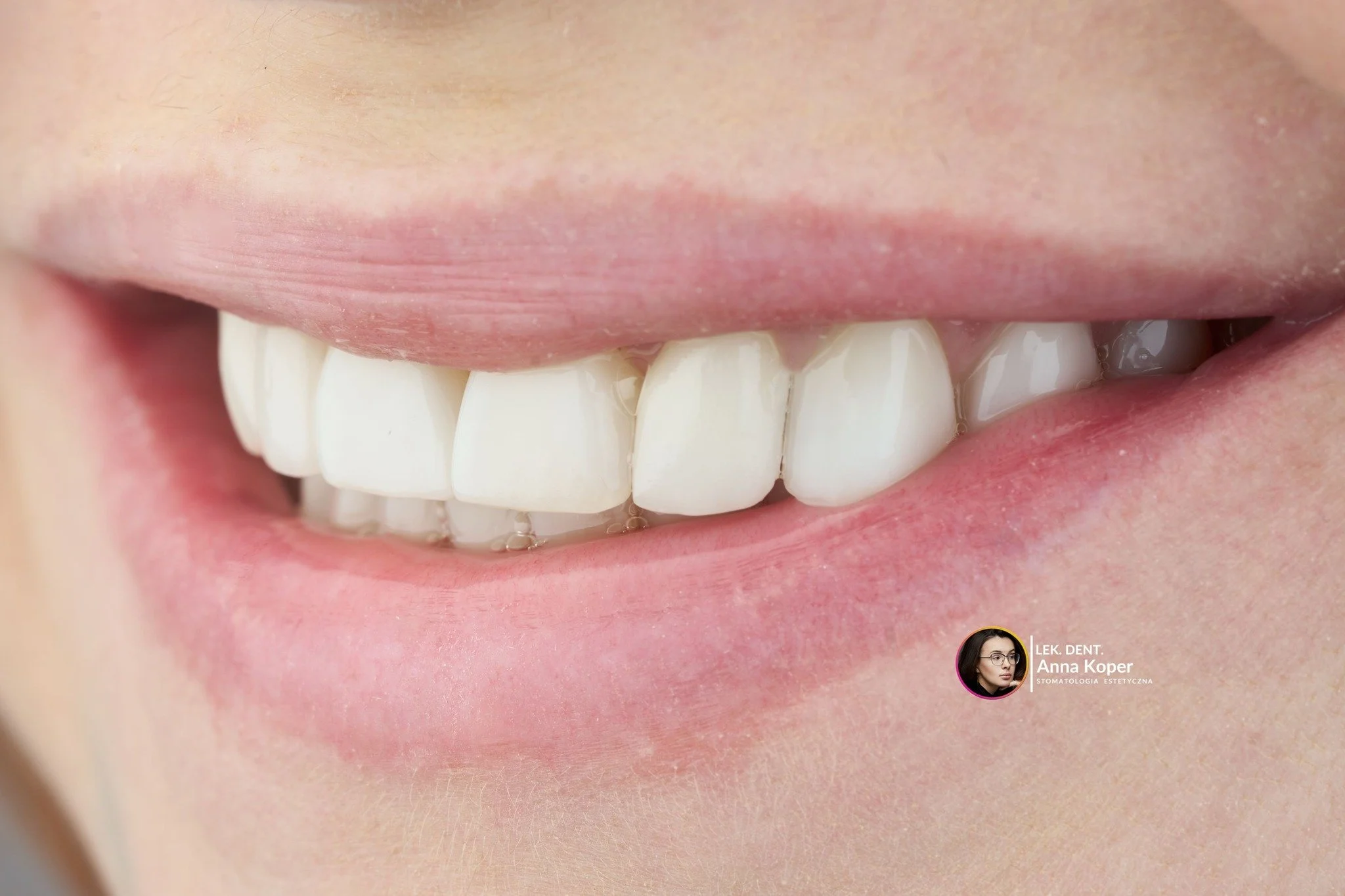 💎 Bonding + Protetyka = Duet Idealny
Czy potrafisz wskazać, kt&oacute;ry ząb to korona, a kt&oacute;ry to bonding? Jeśli nie &ndash; o to właśnie chodziło! 🎯

Prawdziwa sztuka w stomatologii estetycznej to takie połączenie r&oacute;żnych metod, by 