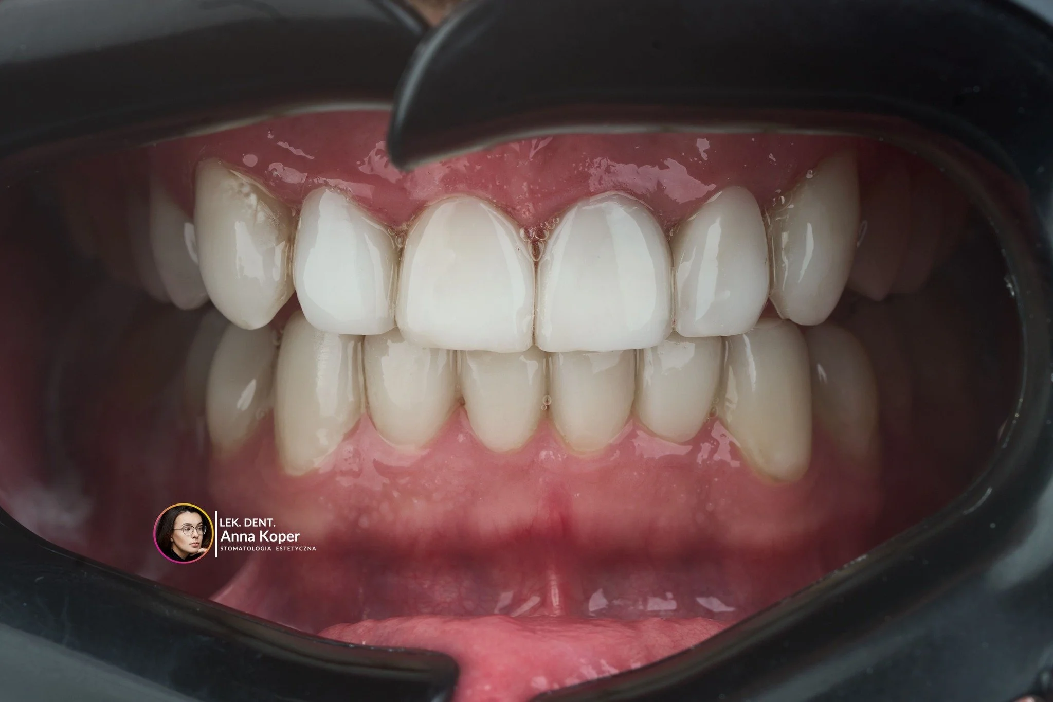 ✨ Jakość, kt&oacute;ra zmienia uśmiech (i życie)
Sp&oacute;jrz na te zdjęcia. Widzisz r&oacute;żnicę między &bdquo;przed&rdquo; a &bdquo;po&rdquo;? To efekt zastosowania najnowocześniejszych materiał&oacute;w, kt&oacute;rych w Estiface używamy w codz