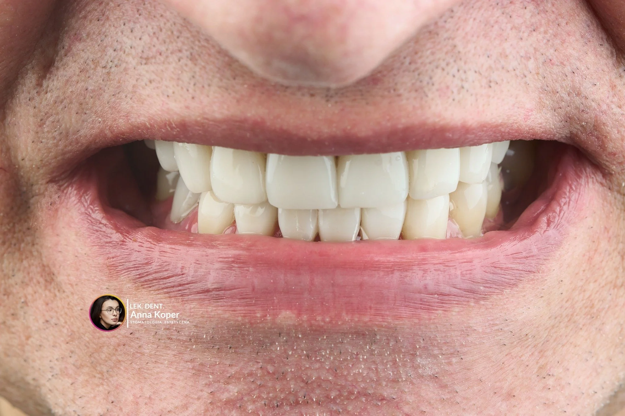 Uśmiech to mechanizm &ndash; jeśli funkcja zawodzi, estetyka nigdy nie będzie trwała. 🛠️✨

Kompleksowa przebudowa to coś więcej niż zmiana wyglądu. To precyzyjne połączenie inżynierii zgryzu z artyzmem odbudowy. W prezentowanym przypadku postawiliśm