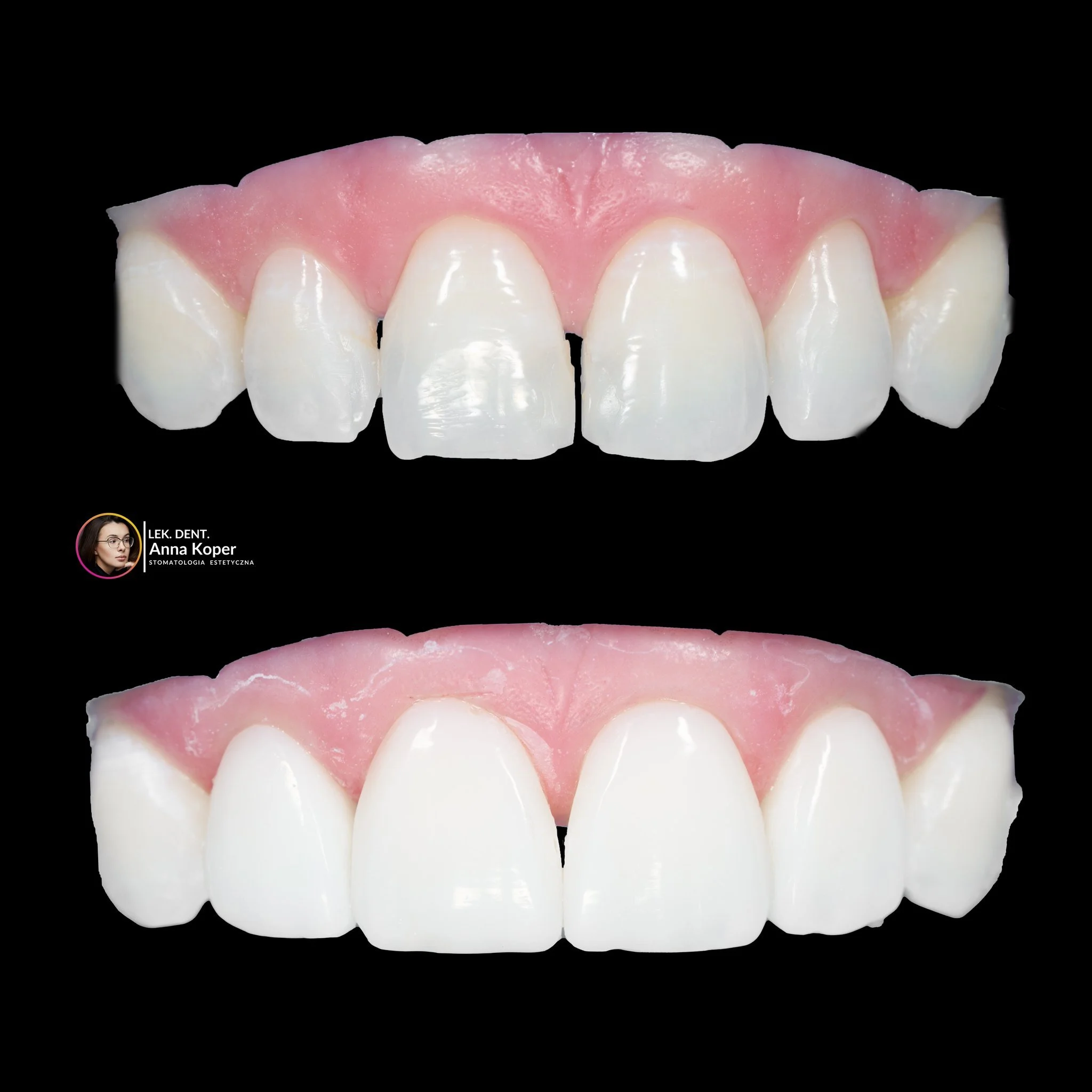 Czy można odmienić uśmiech podczas jednej wizyty? W Estiface udowadniamy, że tak! Prezentujemy efekty metamorfozy, kt&oacute;ra przywr&oacute;ciła naszej Pacjentce pewność siebie i blask.

To, co widzicie na zdjęciach, to efekt około 2 godzin precyzy