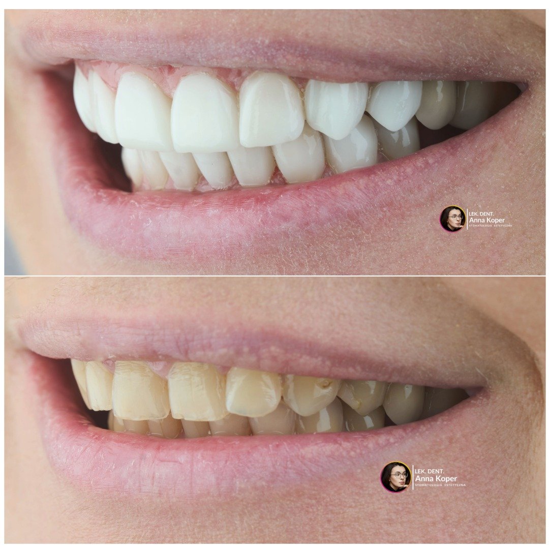 🌸 Wiosna to dobry moment na zmiany &mdash; r&oacute;wnież te w uśmiechu.
Robi się cieplej, dni są dłuższe, a my częściej się uśmiechamy &mdash; do znajomych, do słońca, do nowego początku. To naturalny czas, kiedy chcemy wyglądać i czuć się lepiej.
