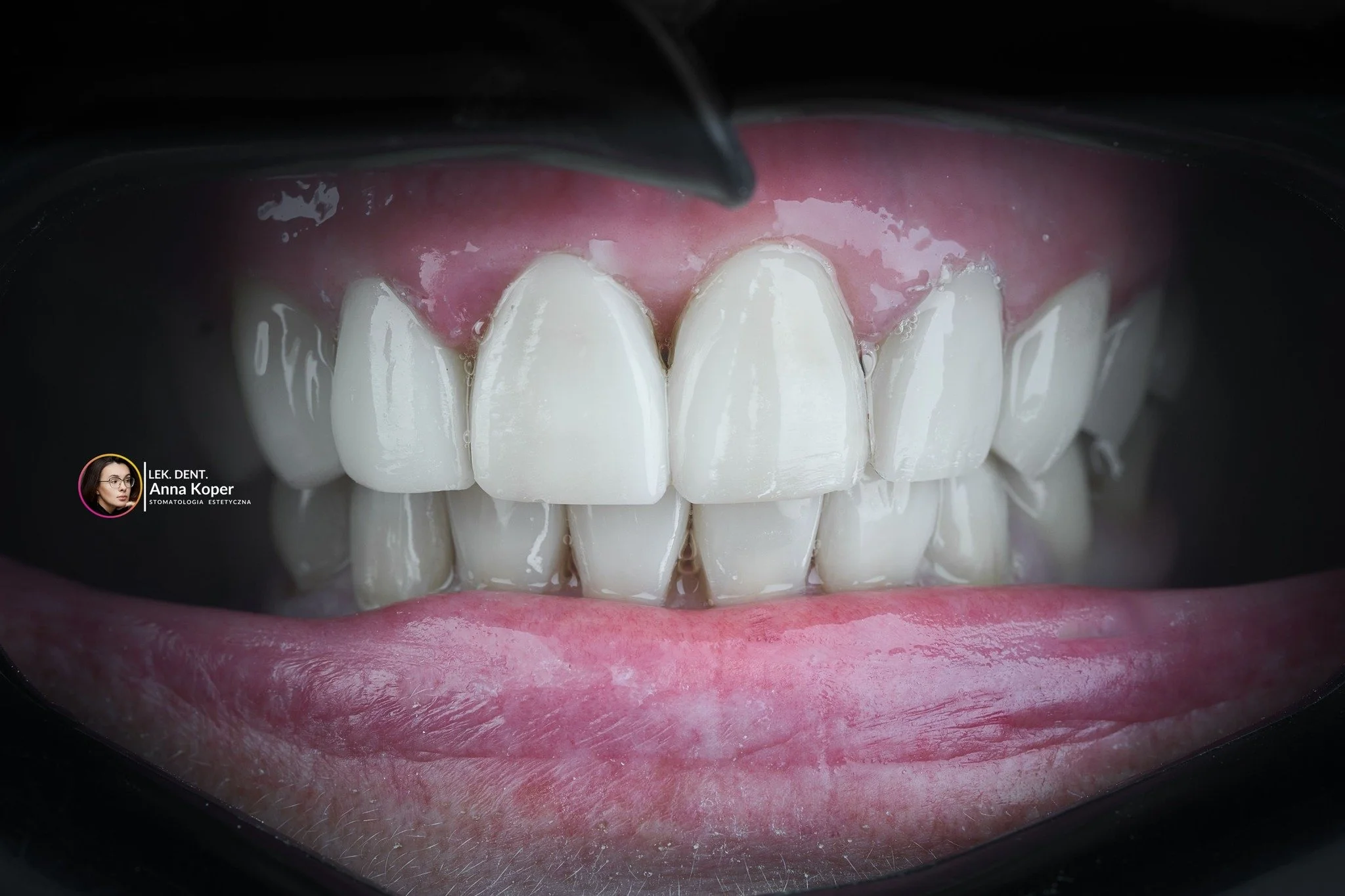 To nie filtr. To nie edycja. To praca, precyzja i pasja do stomatologii estetycznej. 🦷
Przebarwienia, starcia, nieregularny kształt &mdash; każdy z tych problem&oacute;w ma swoje rozwiązanie. Razem możemy stworzyć uśmiech, kt&oacute;ry dodaje pewnoś